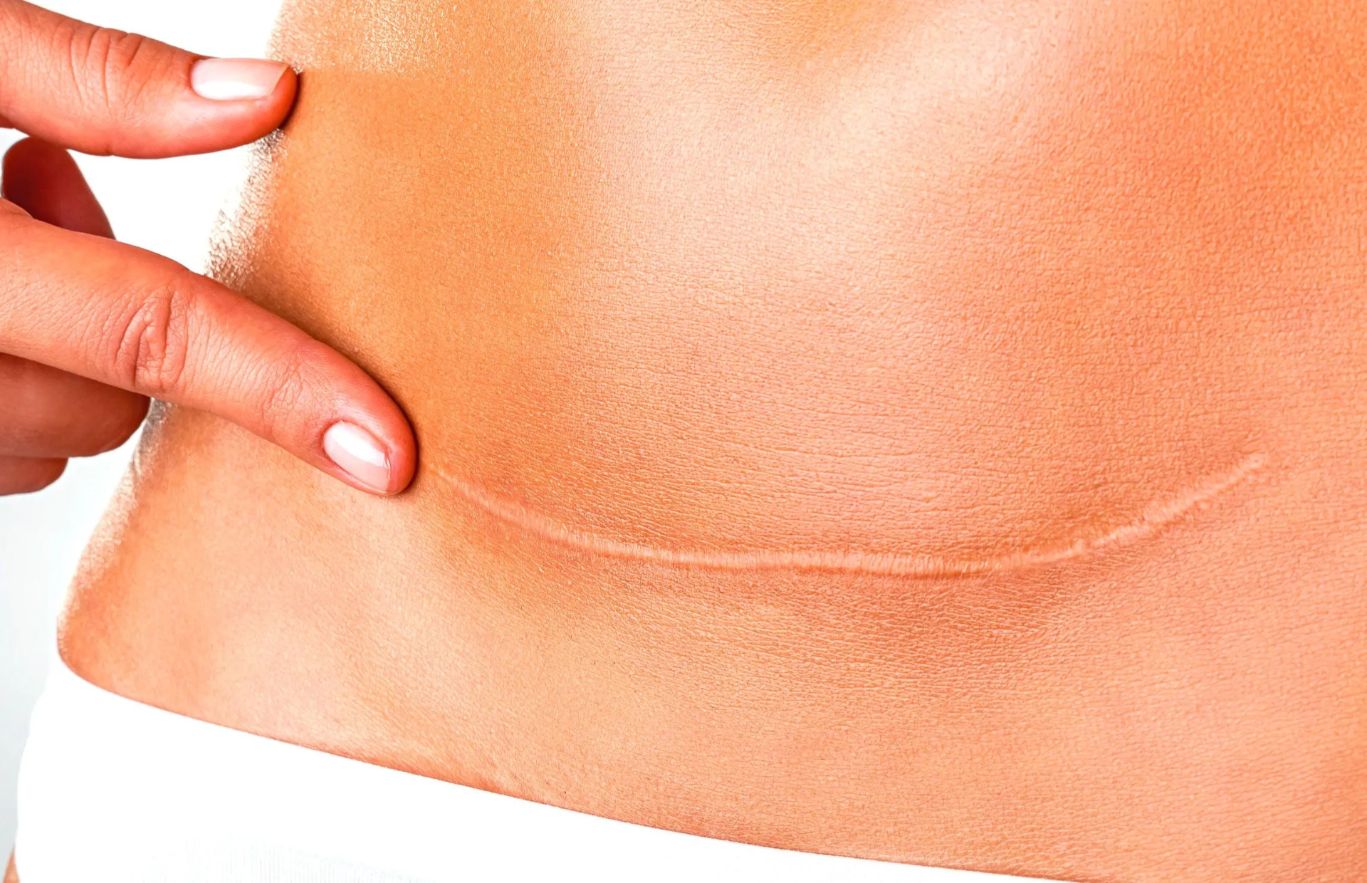 Fisioterapia para Cicatrices y Adherencias