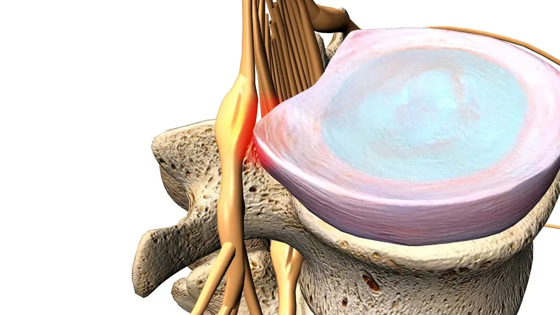 Fisioterapia para Dolor Radicular