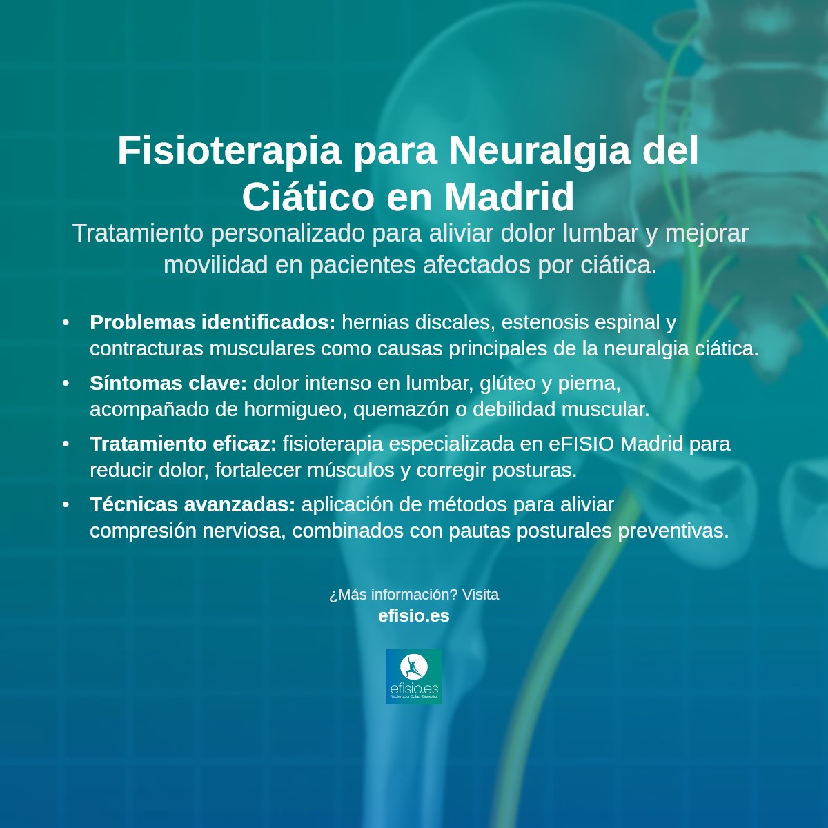 Imagen resumen sobre Neuralgia del Ciático