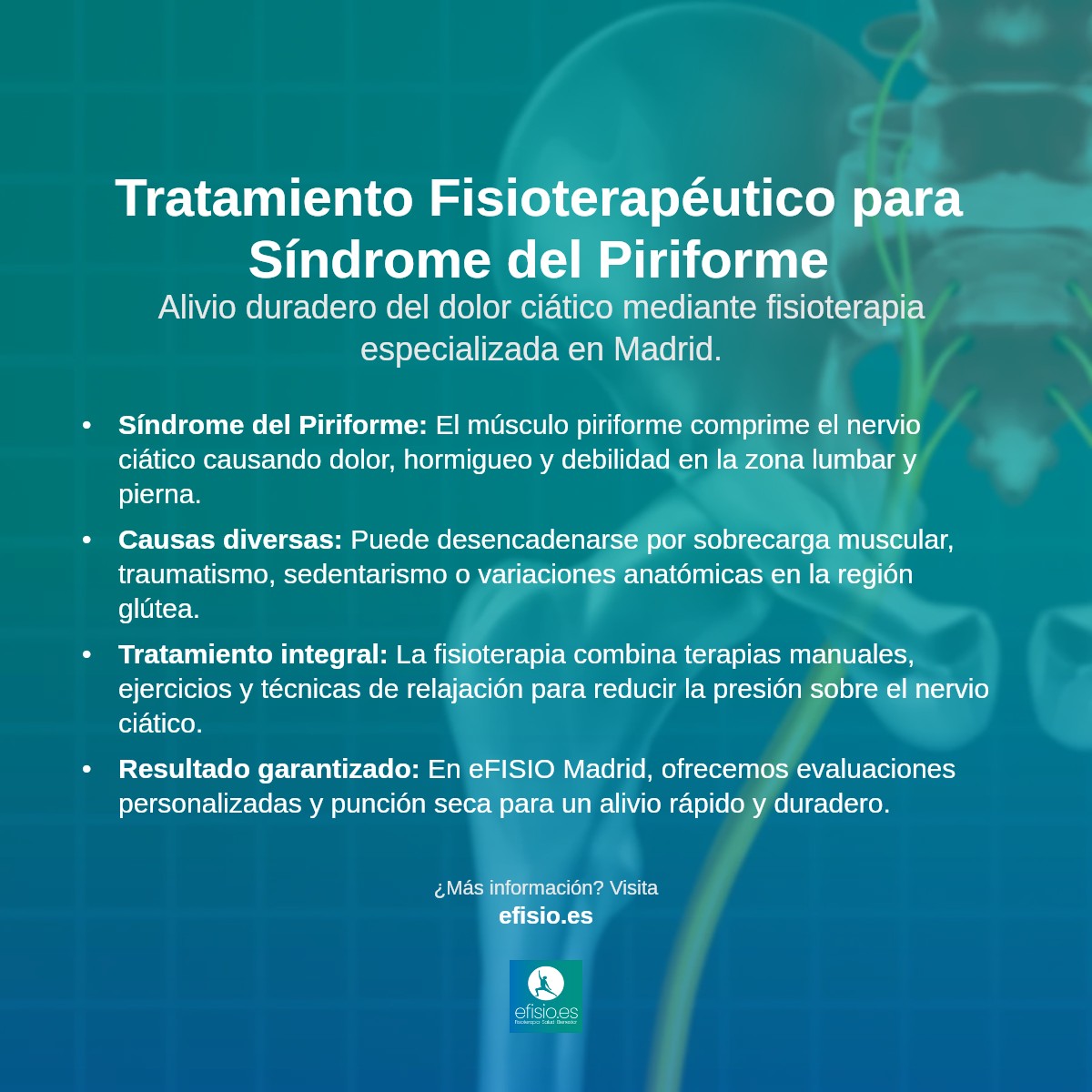 Imagen resumen sobre Síndrome del Piriforme (Afectación Nervio Ciático)