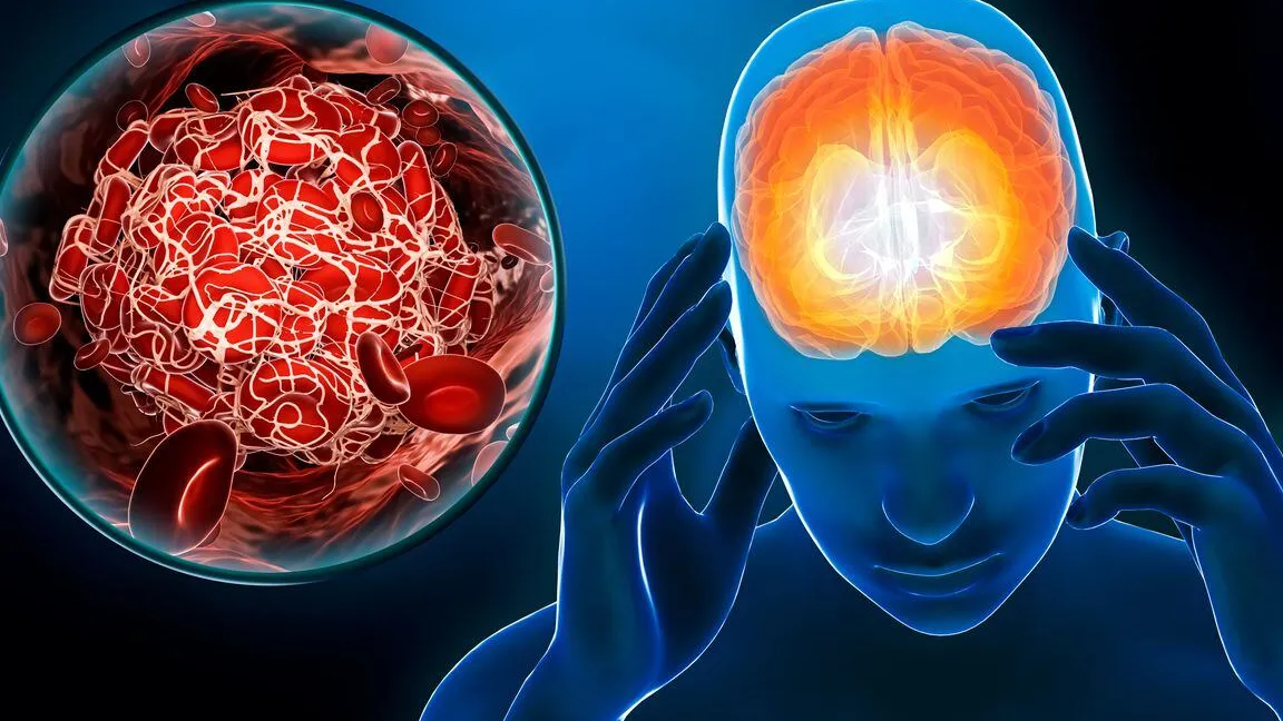 Accidente Cerebrovascular (ACV) o Ictus