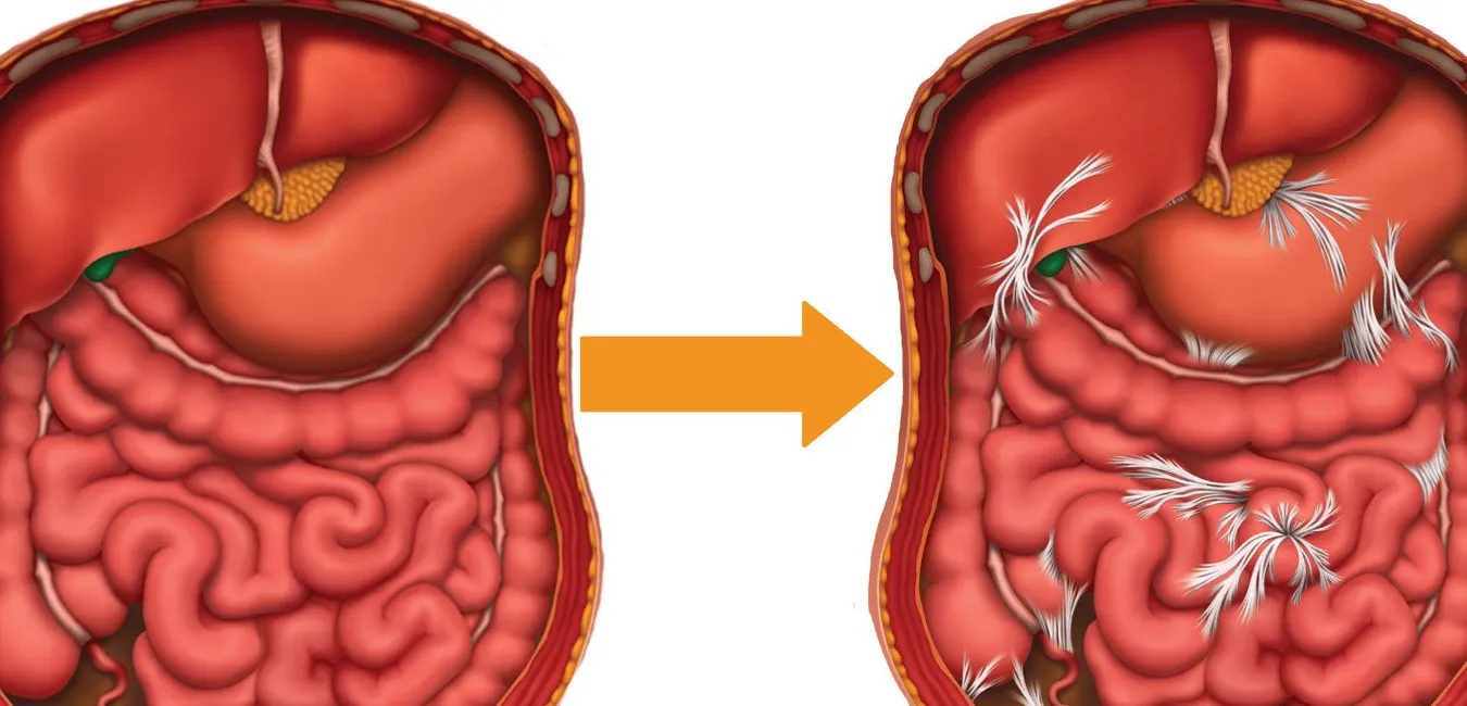 Adherencias Postquirúrgicas en el Abdomen