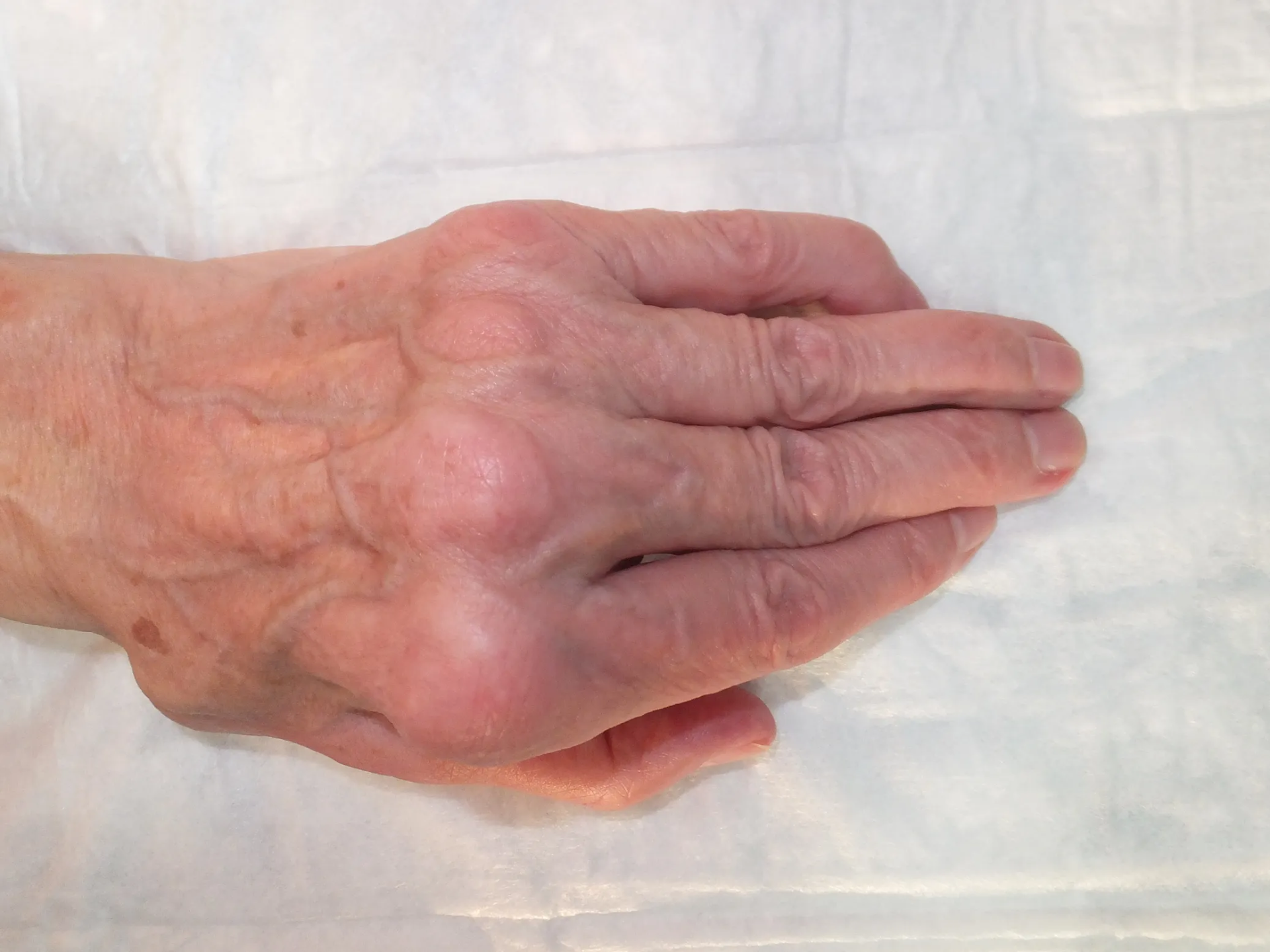 Artritis de Muñeca