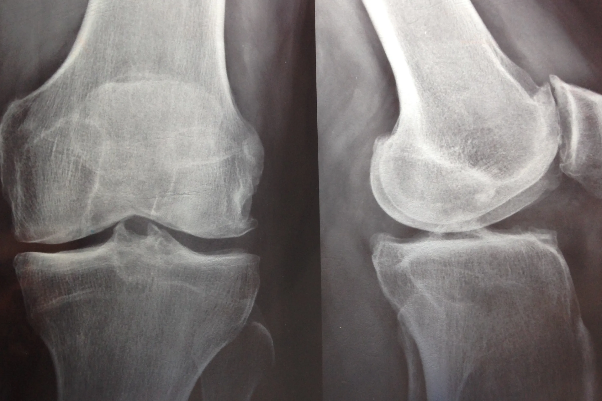 Artrosis de rodilla