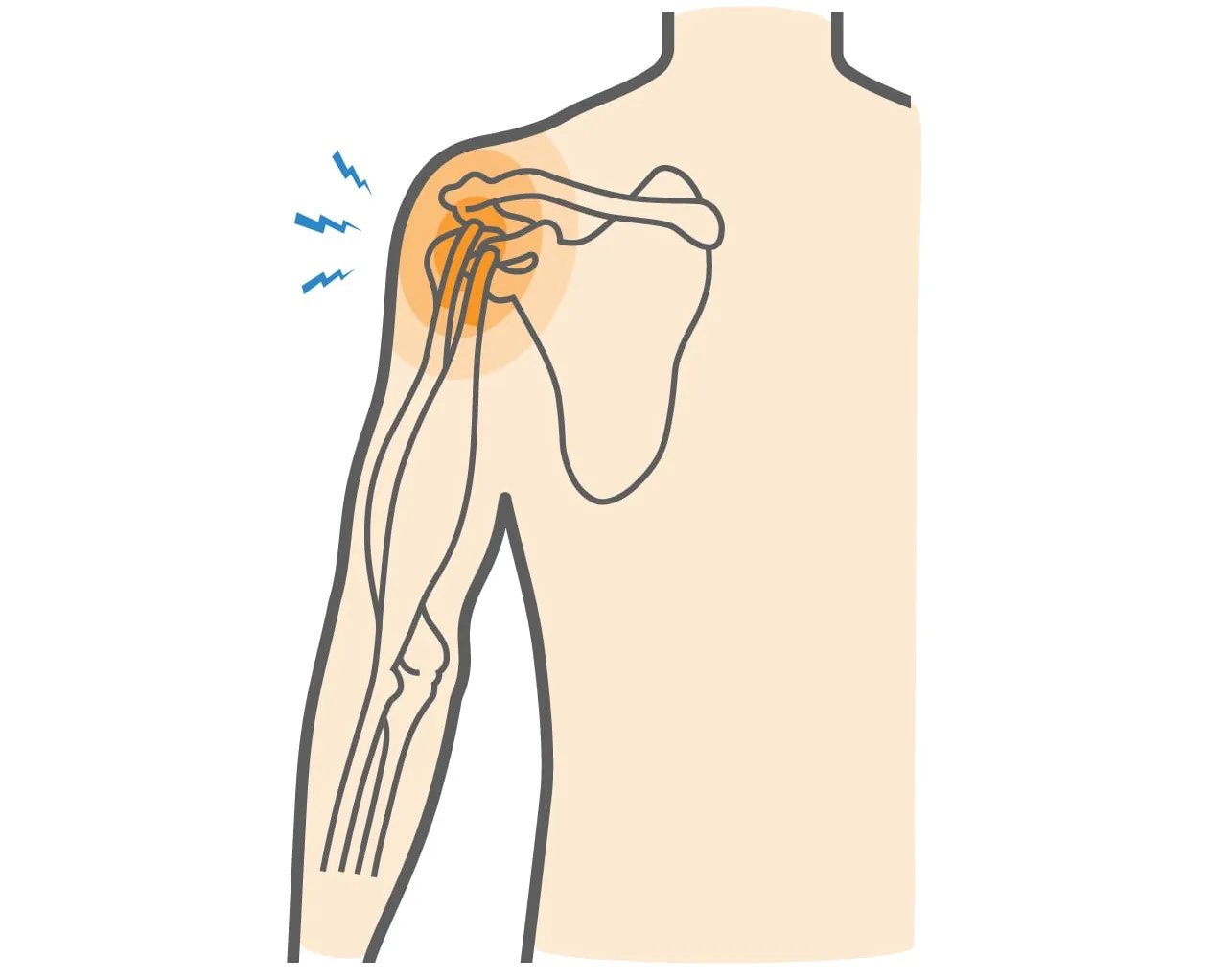 Tendinitis Bicipital