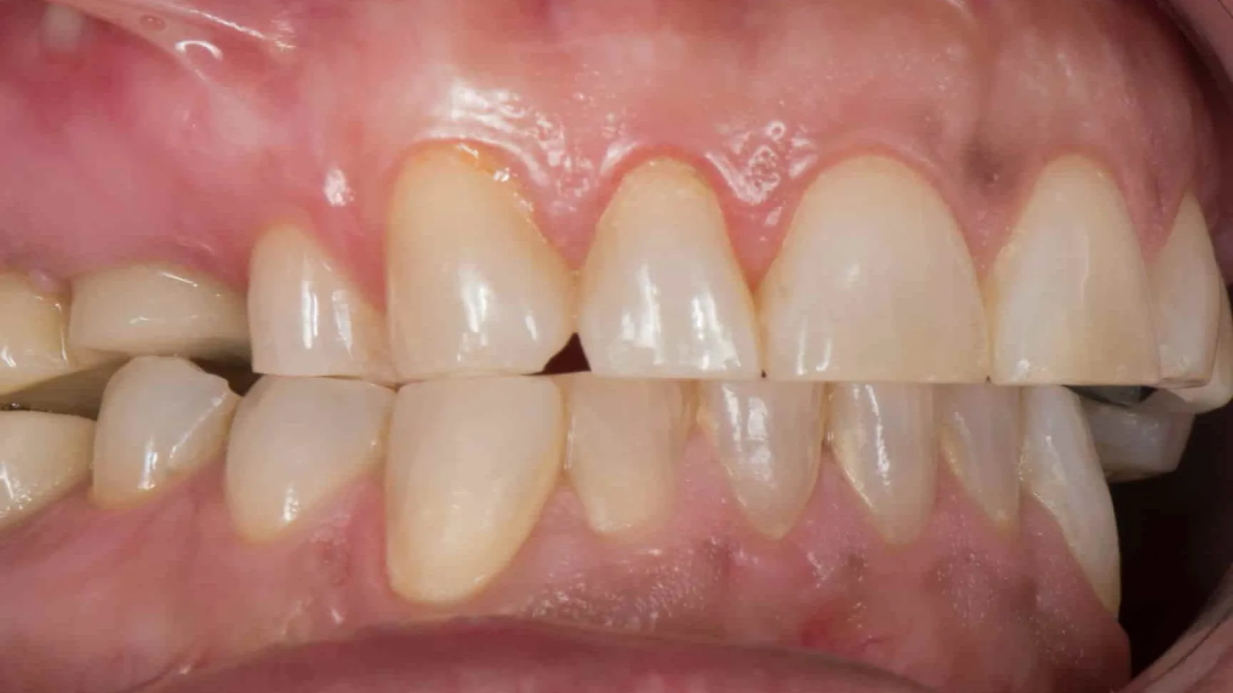 Bruxismo (rechinar de dientes)