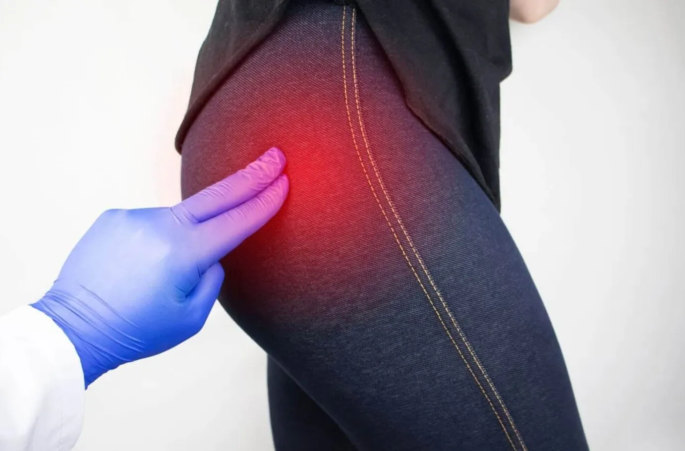 Bursitis de Cadera