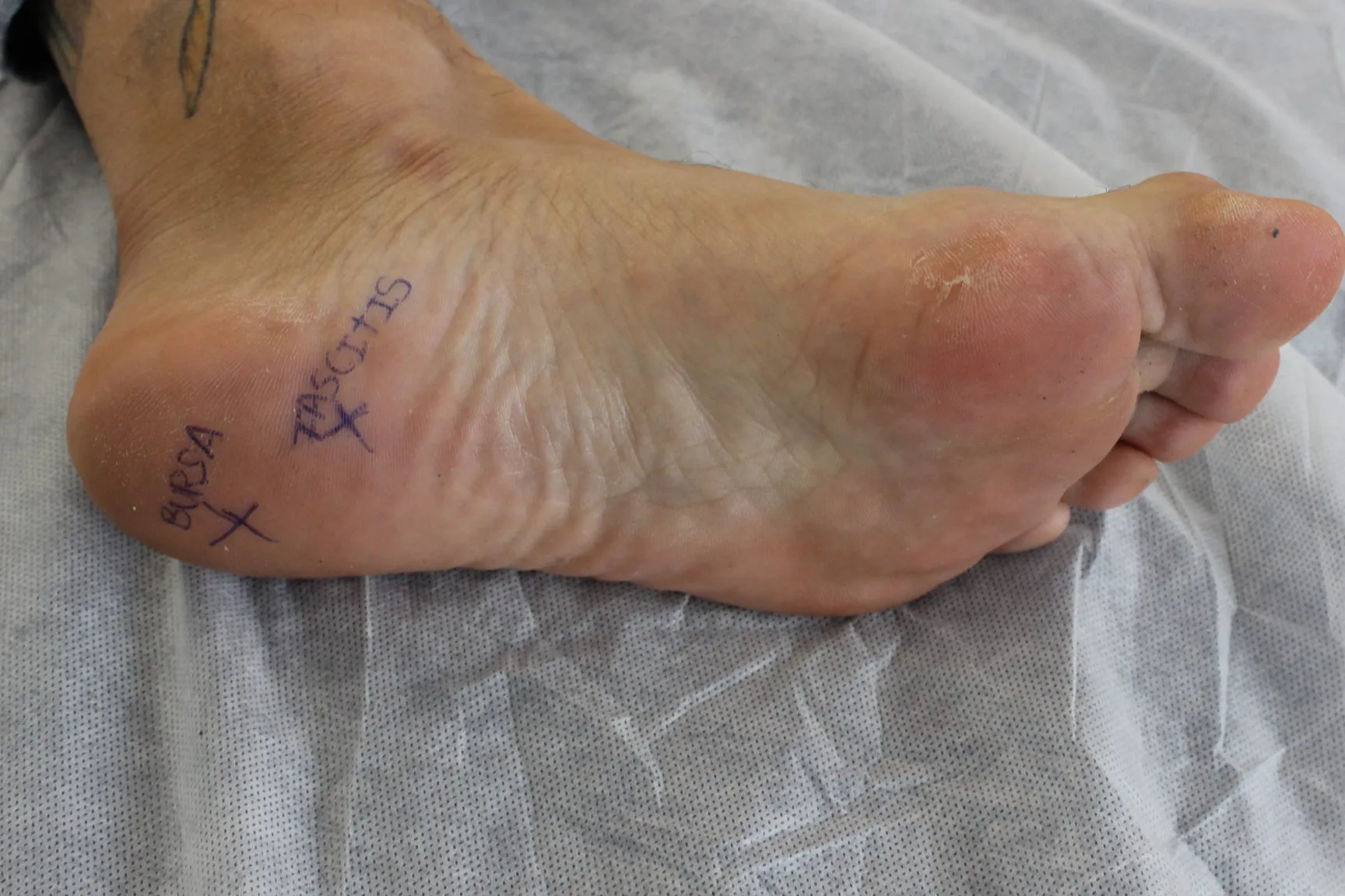 Bursitis en el Pie