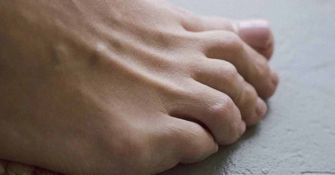 calambres en los dedos de los pies