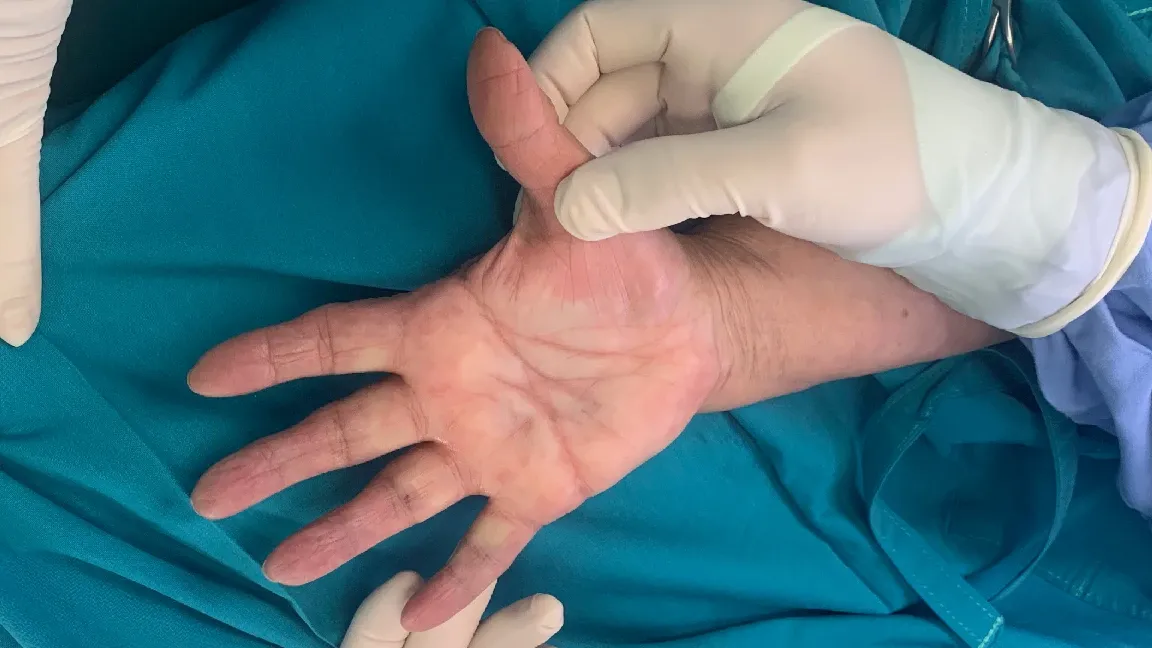 Capsulitis en Dedos (p.ej., Dedo en Gatillo)