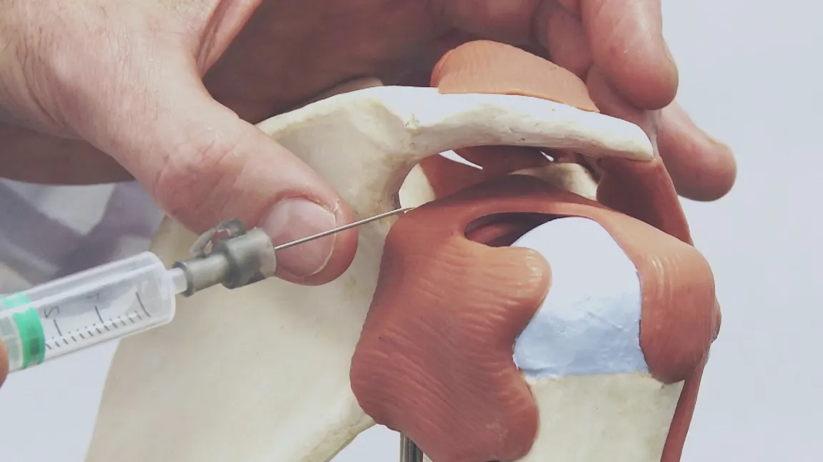 Capsulitis de Muñeca