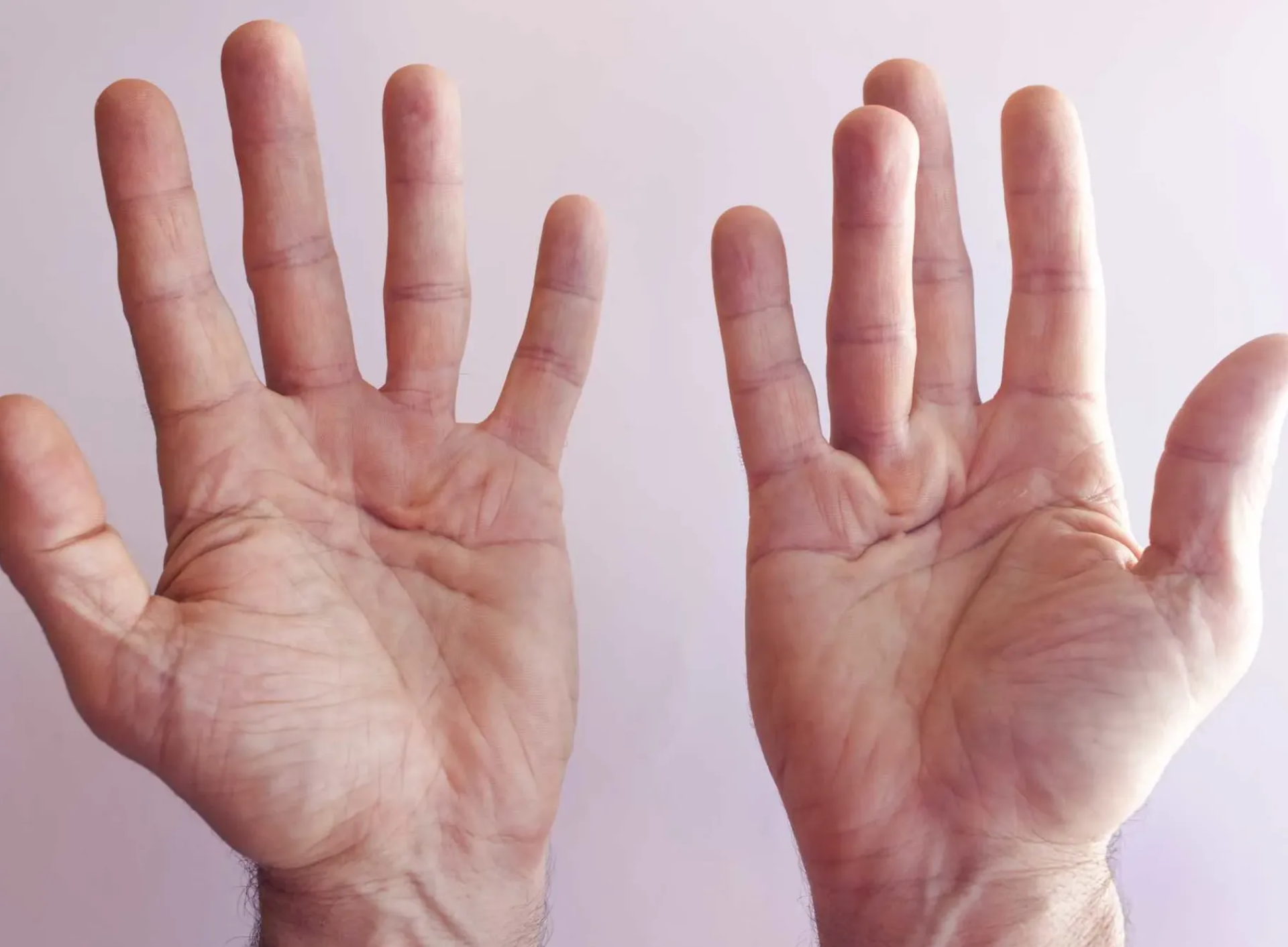 Contractura de Dupuytren
