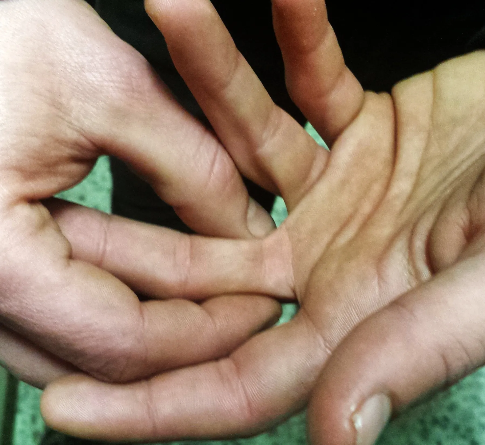 Dolor en la Base de los Dedos (Manos)
