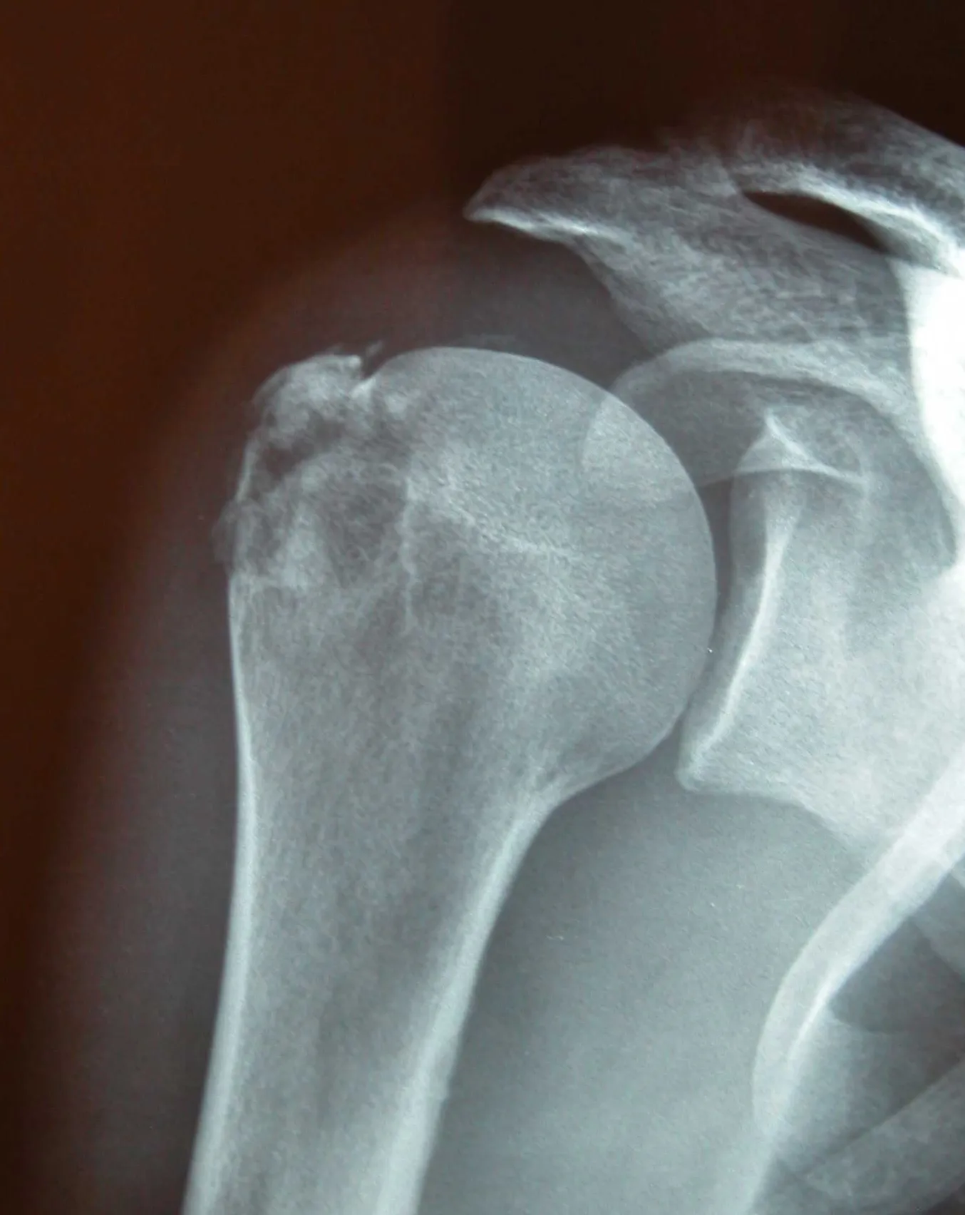 Dolor en la Clavícula