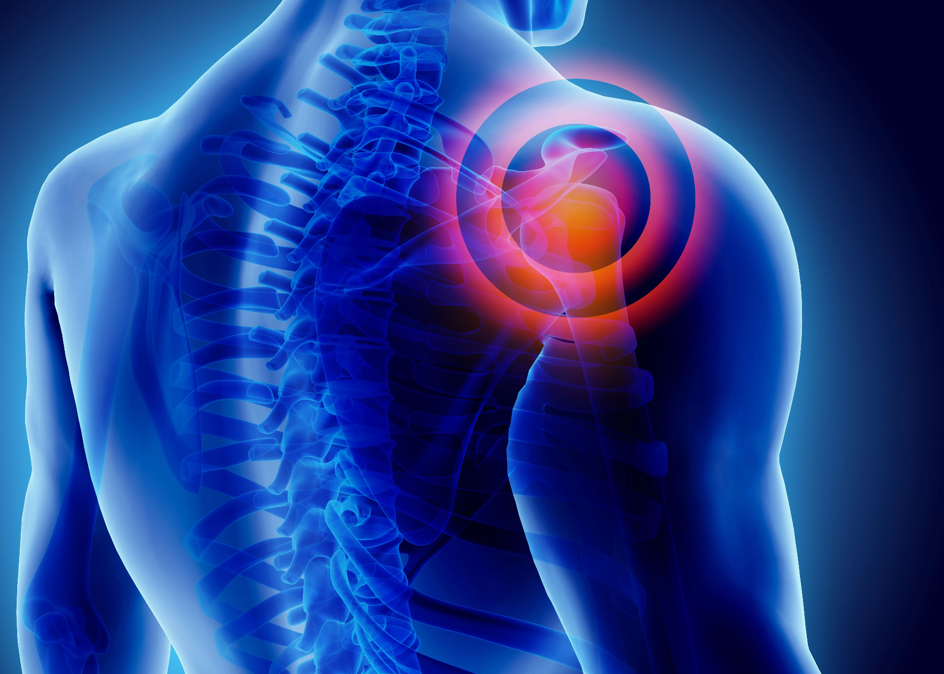 Dolor Miofascial en Cuello y Clavícula