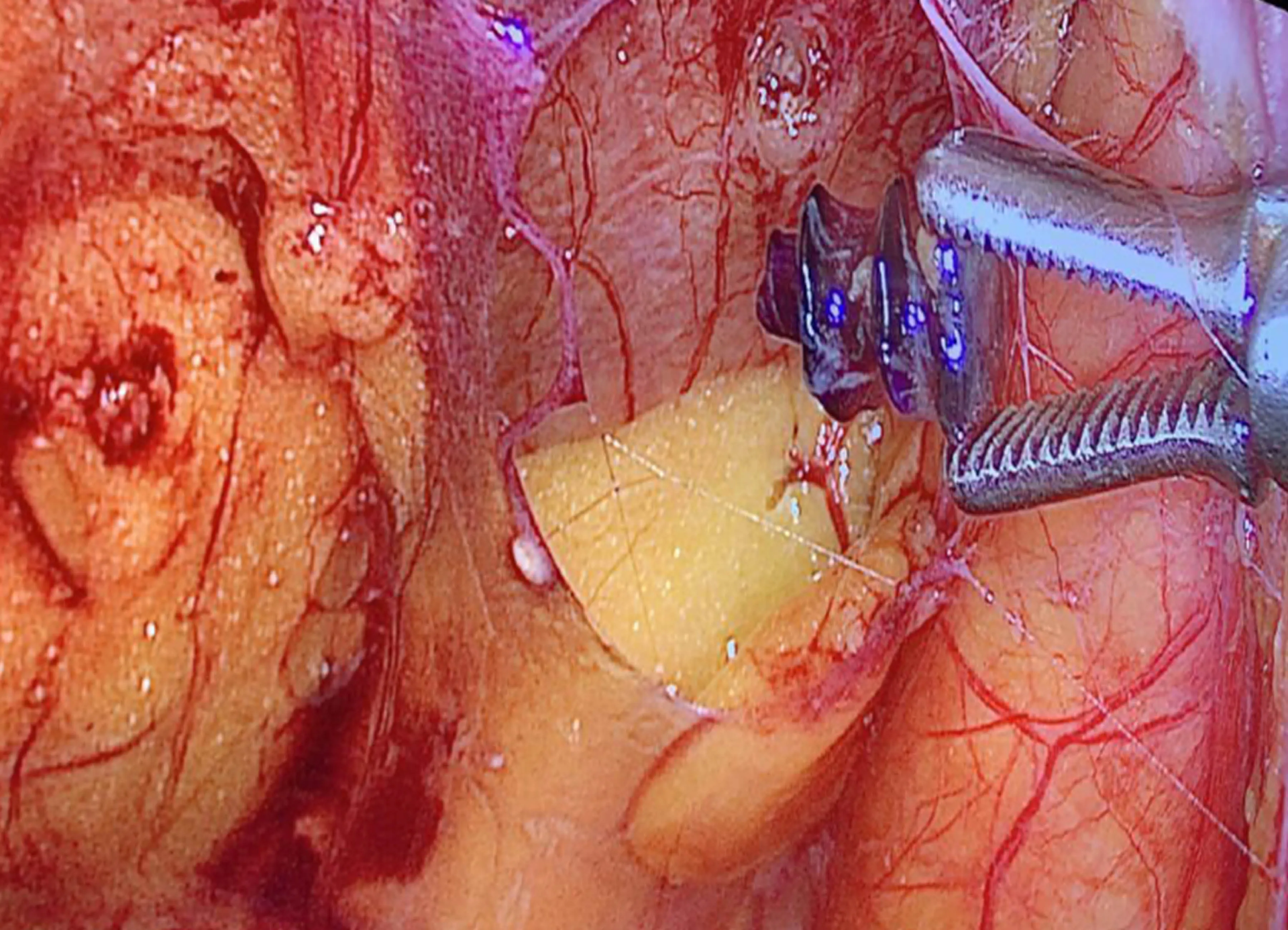 Dolor del Nervio Ilioinguinal