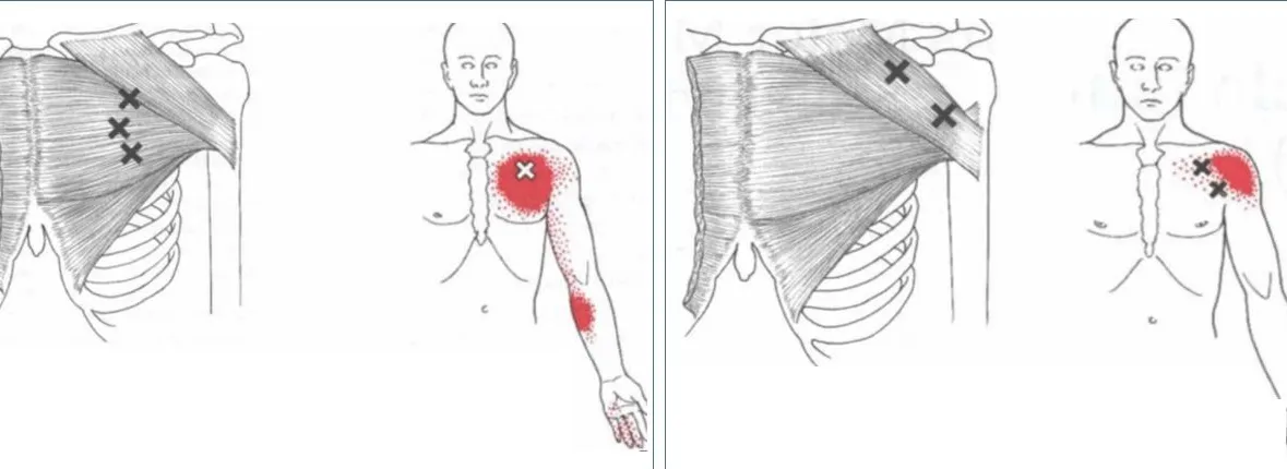 Dolor Postural Afectando los Pectorales