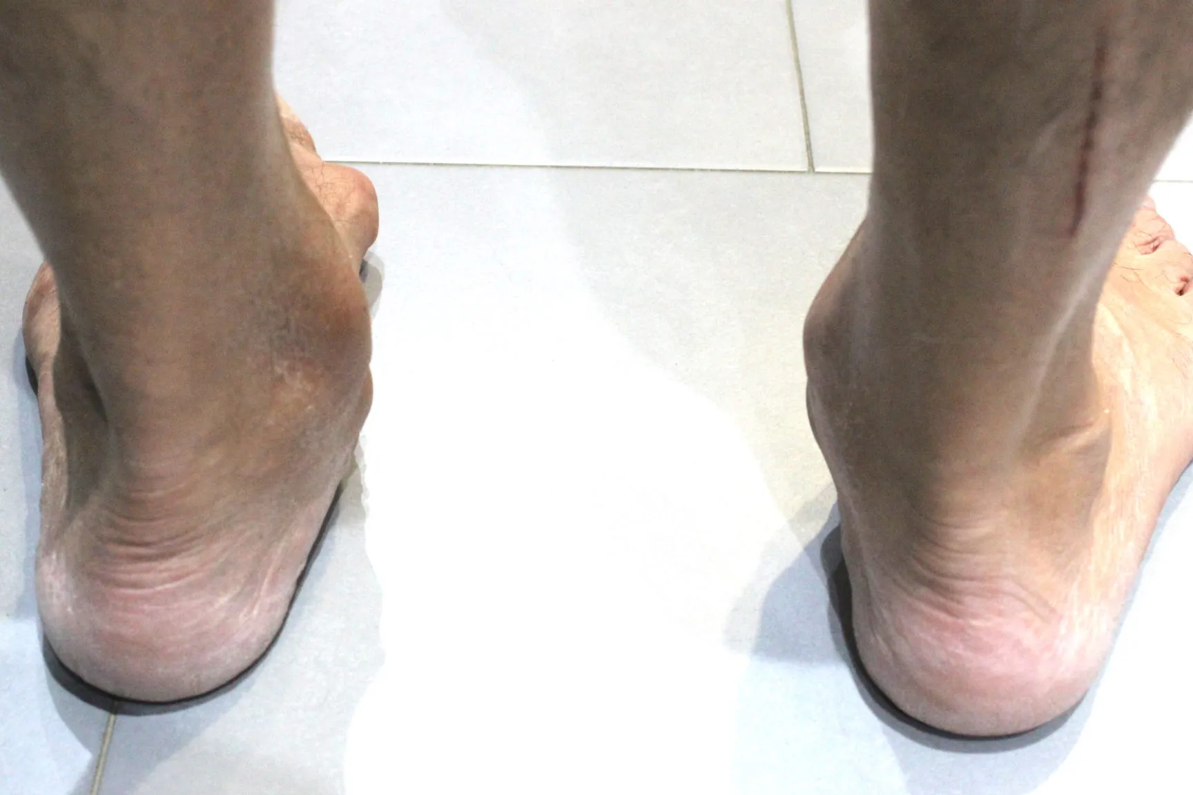 Dolor tobillo interno