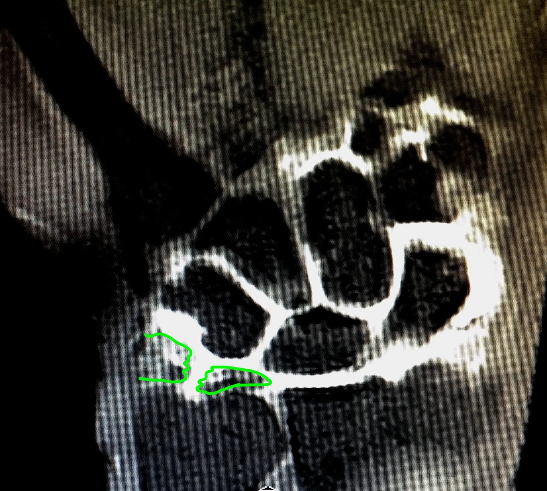 Esguince de Ligamento Triangular de la Muñeca