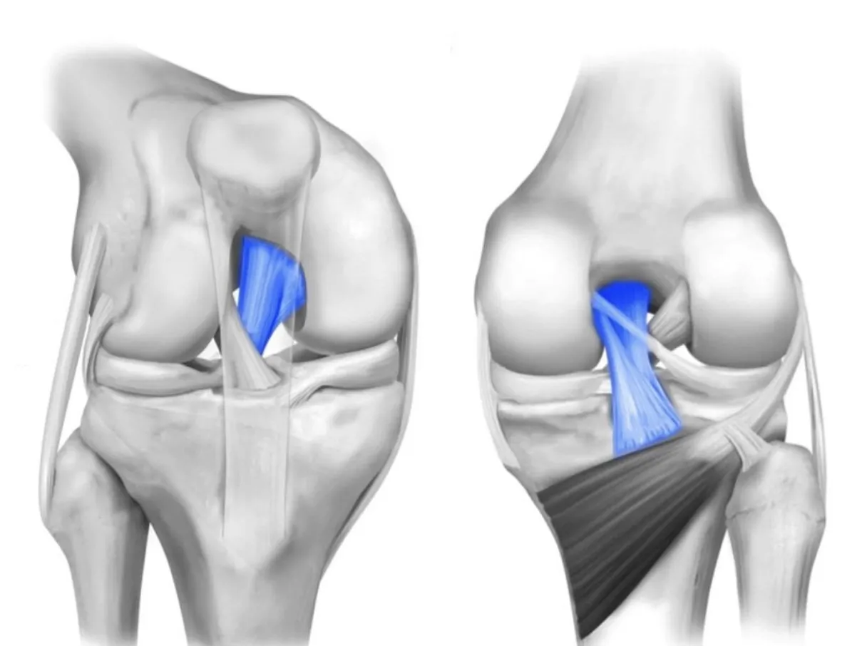 Esguince de Ligamento Cruzado Posterior (LCP)