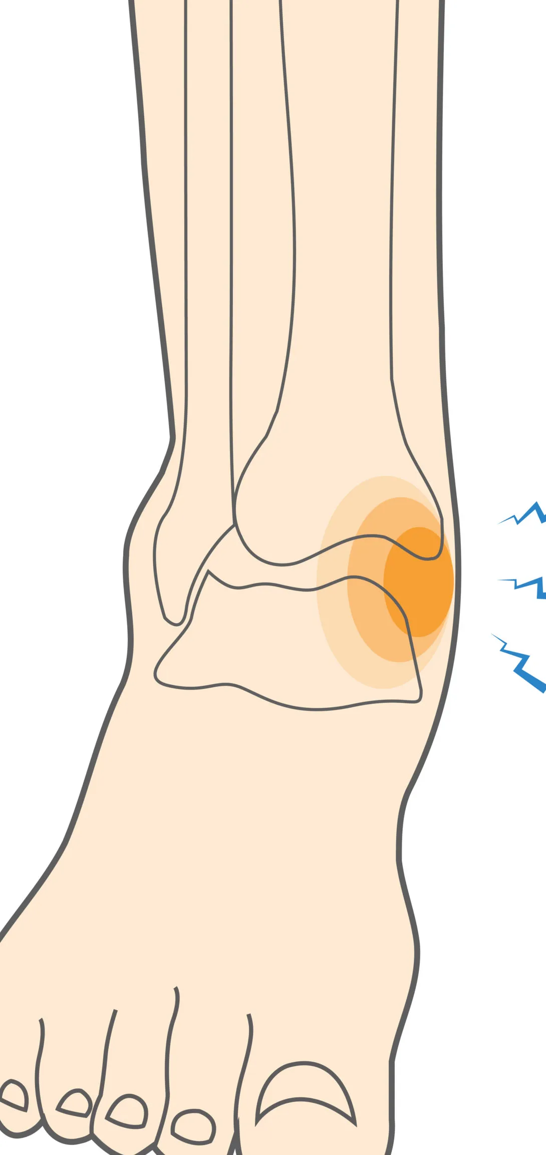 Esguince de Ligamento Deltoides