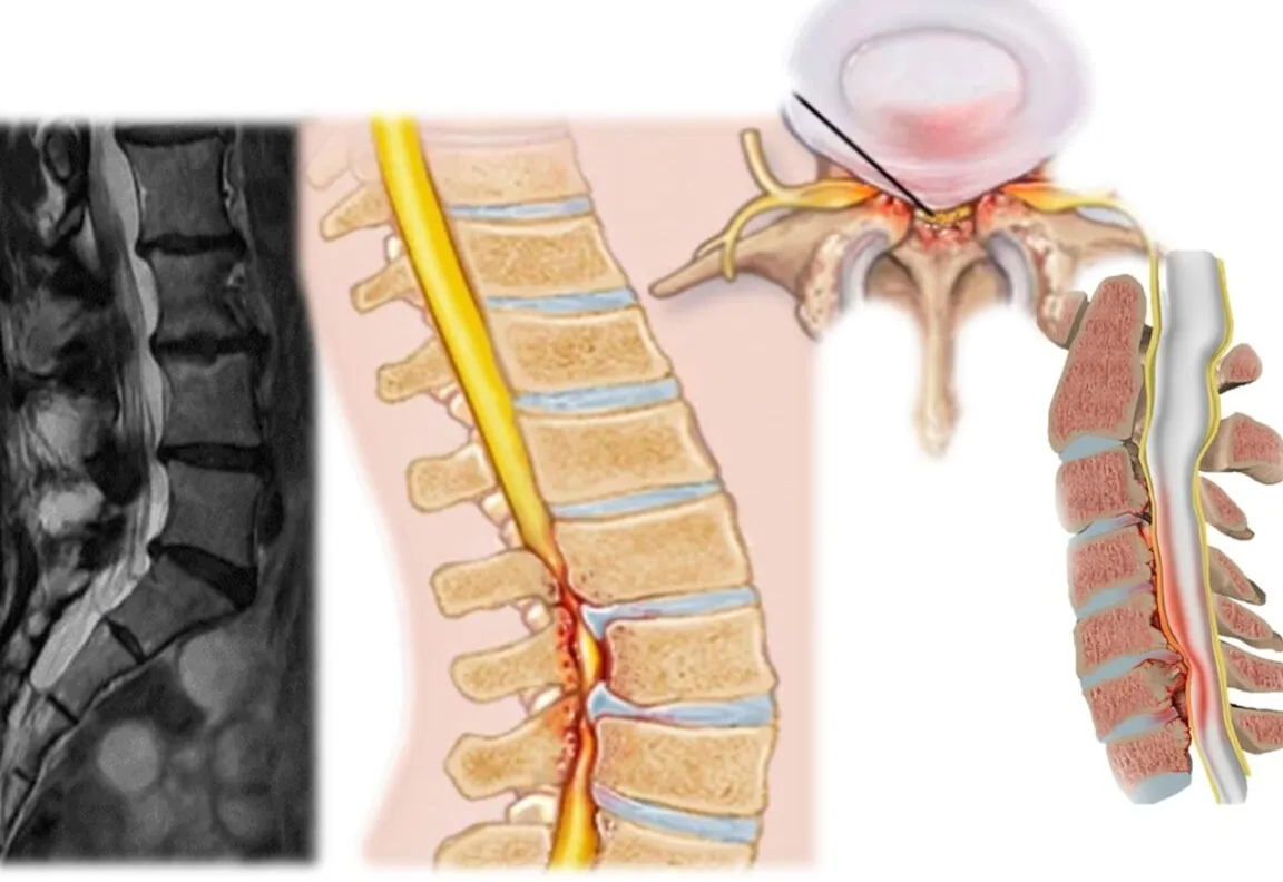 Estenosis del Canal Cervical