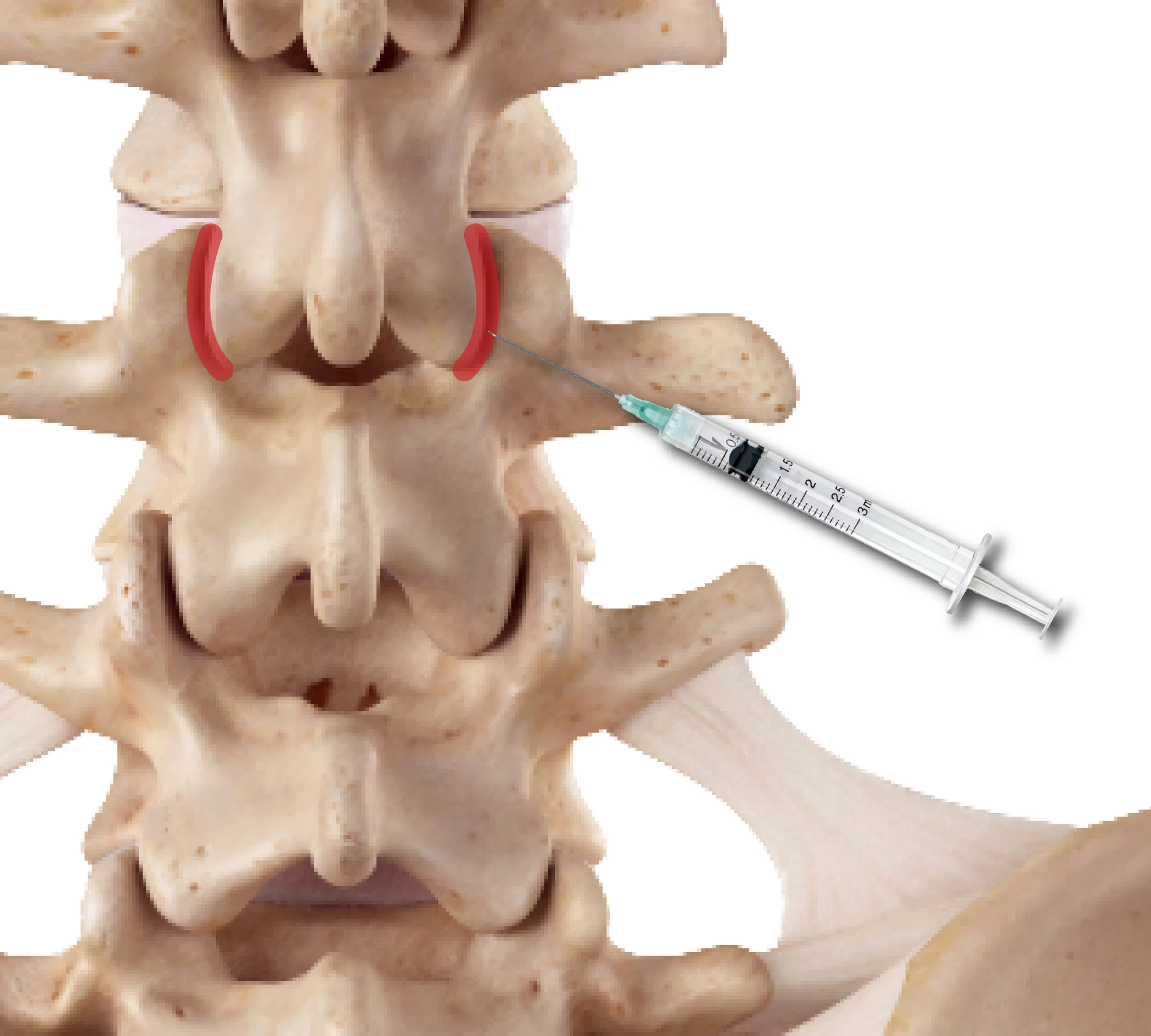 Artrosis Facetaria Lumbar