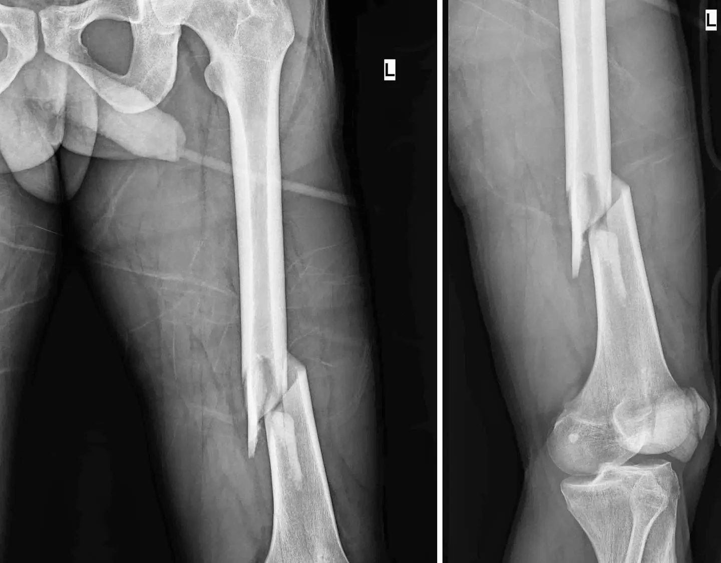 Fractura de fémur posoperatoria