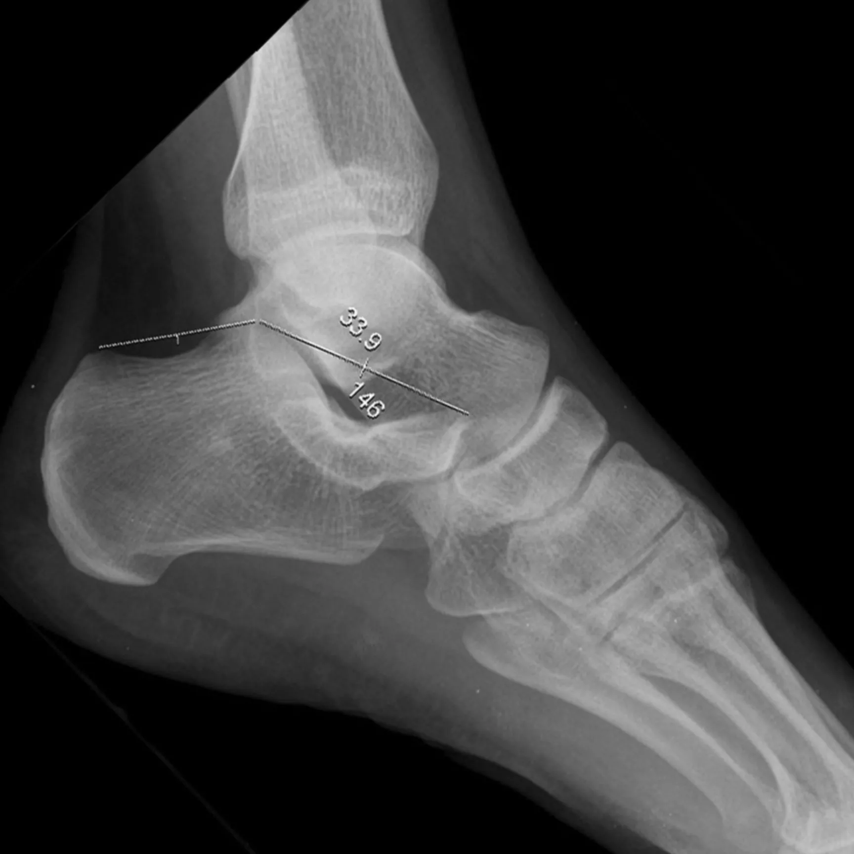 Fracturas del Calcáneo