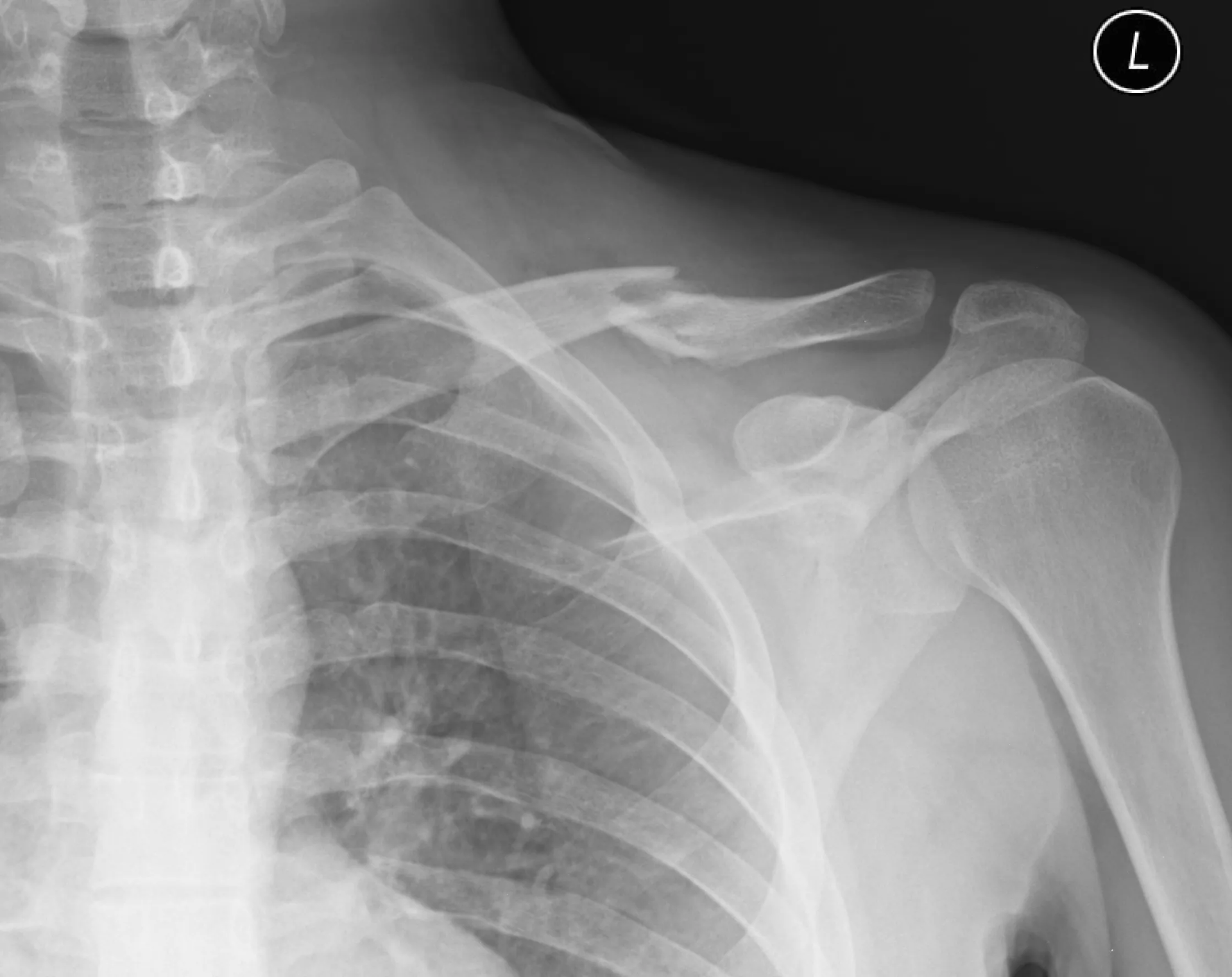 Fracturas de Clavícula