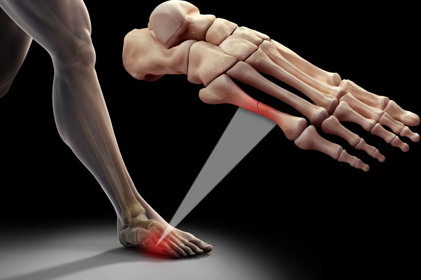 Fracturas de Metatarsos