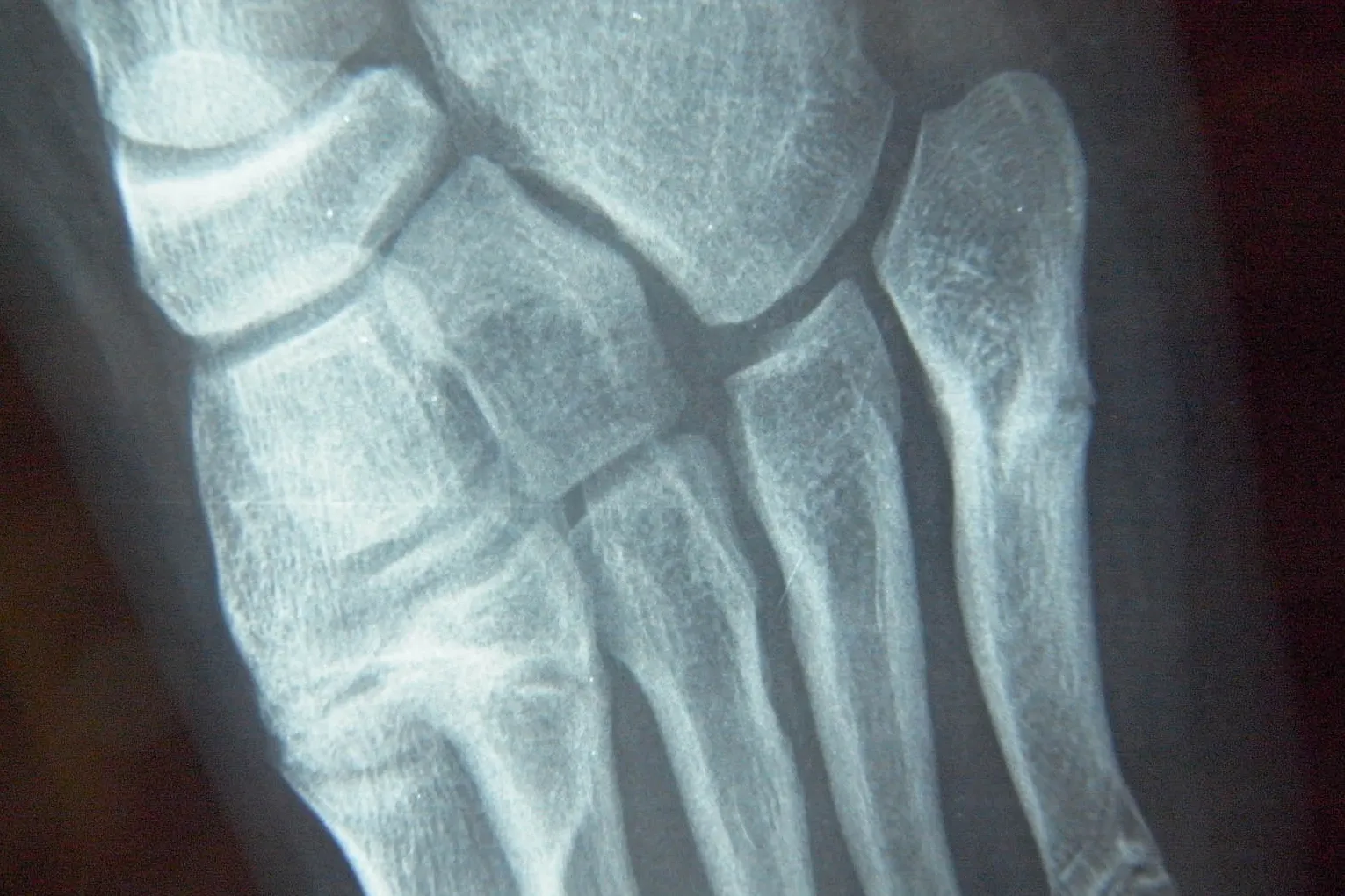 Fracturas de Stress en el Pie