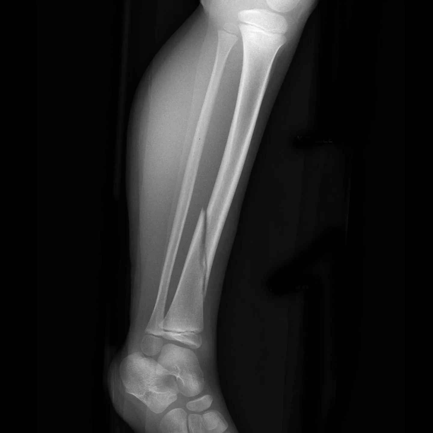 Fracturas de tibia y peroné