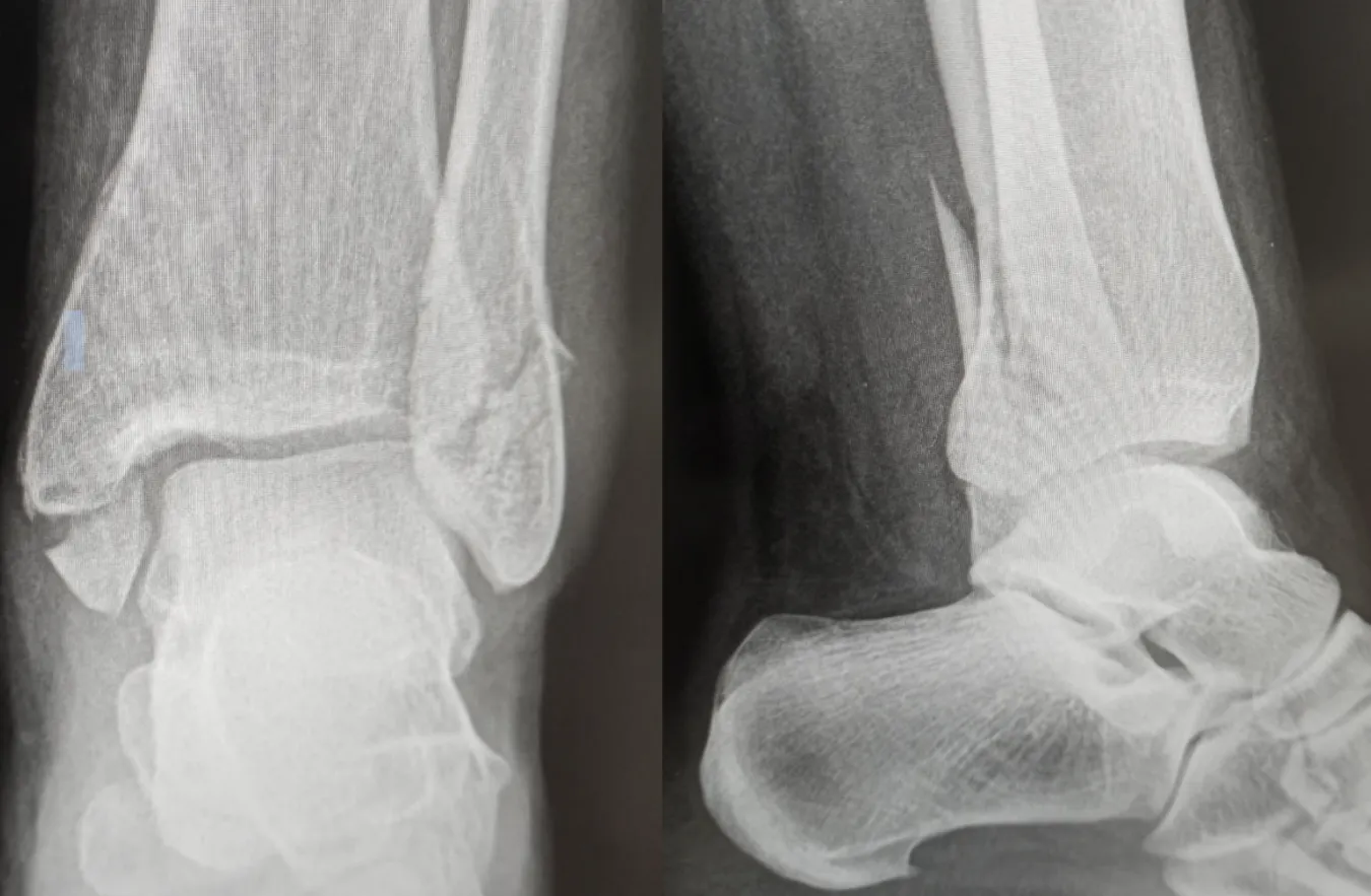 Fracturas de Tobillo