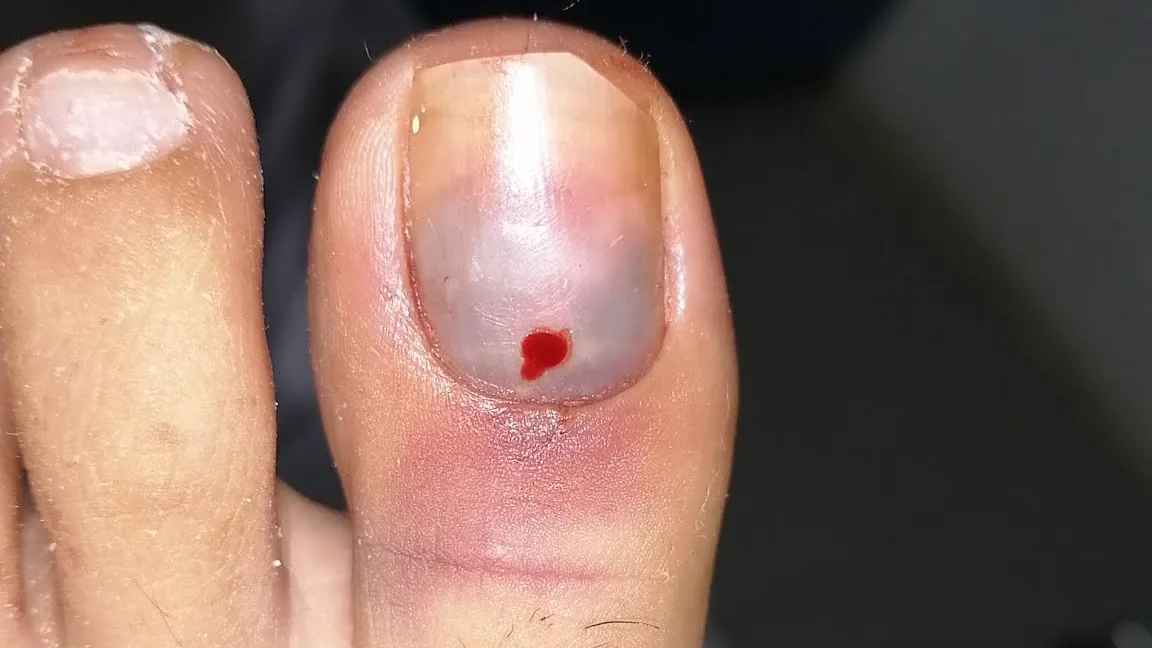 Hematoma por golpe