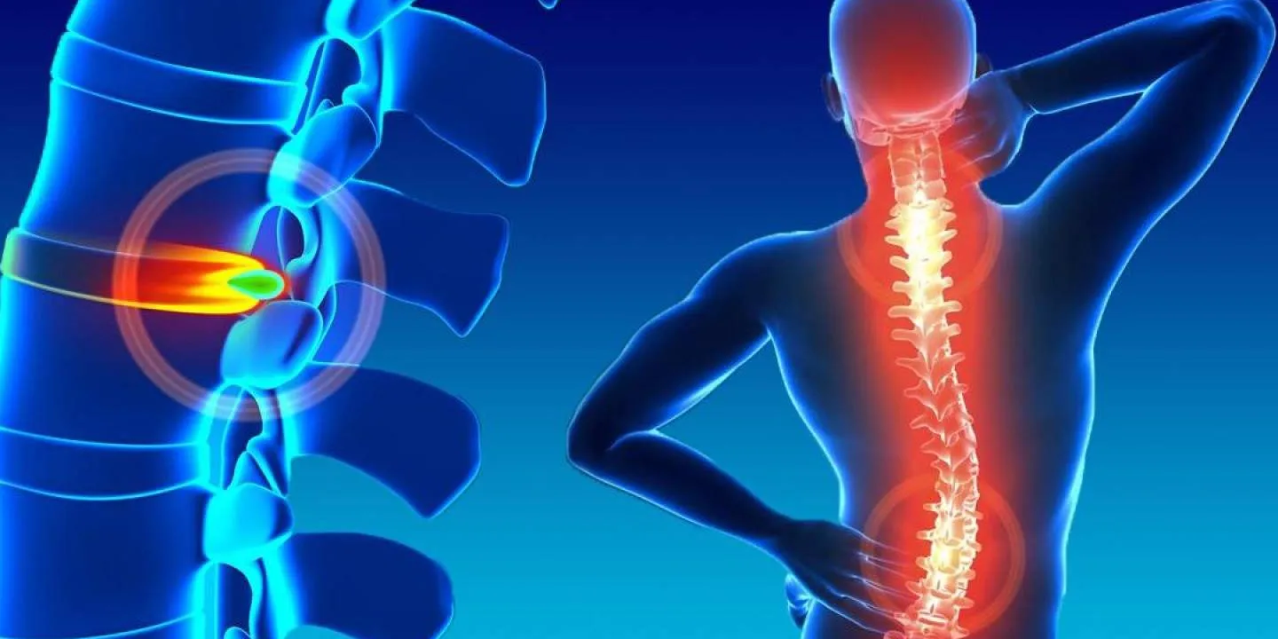Hernia de Disco Lumbar