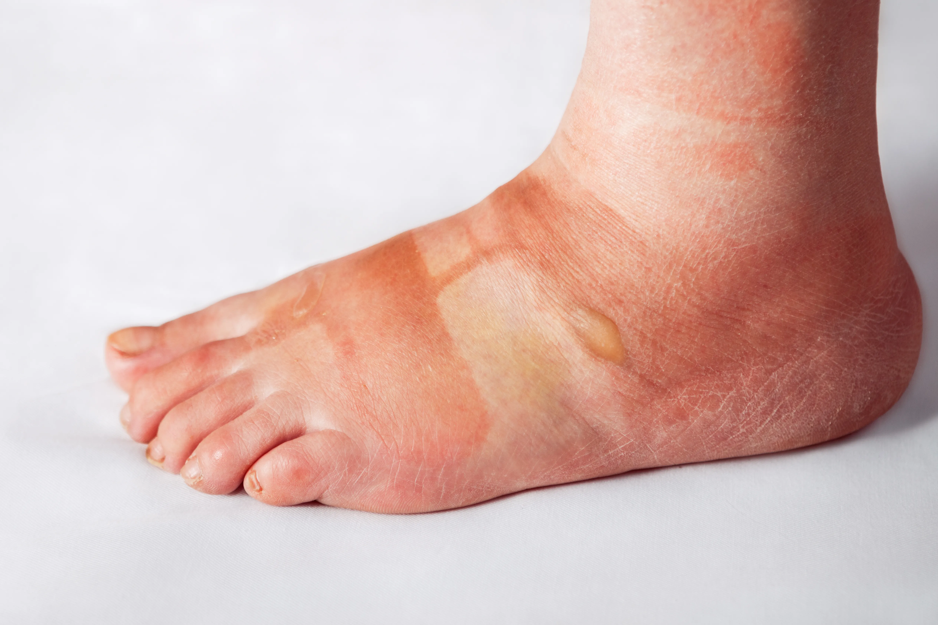 Hinchazón o edema postoperatorio