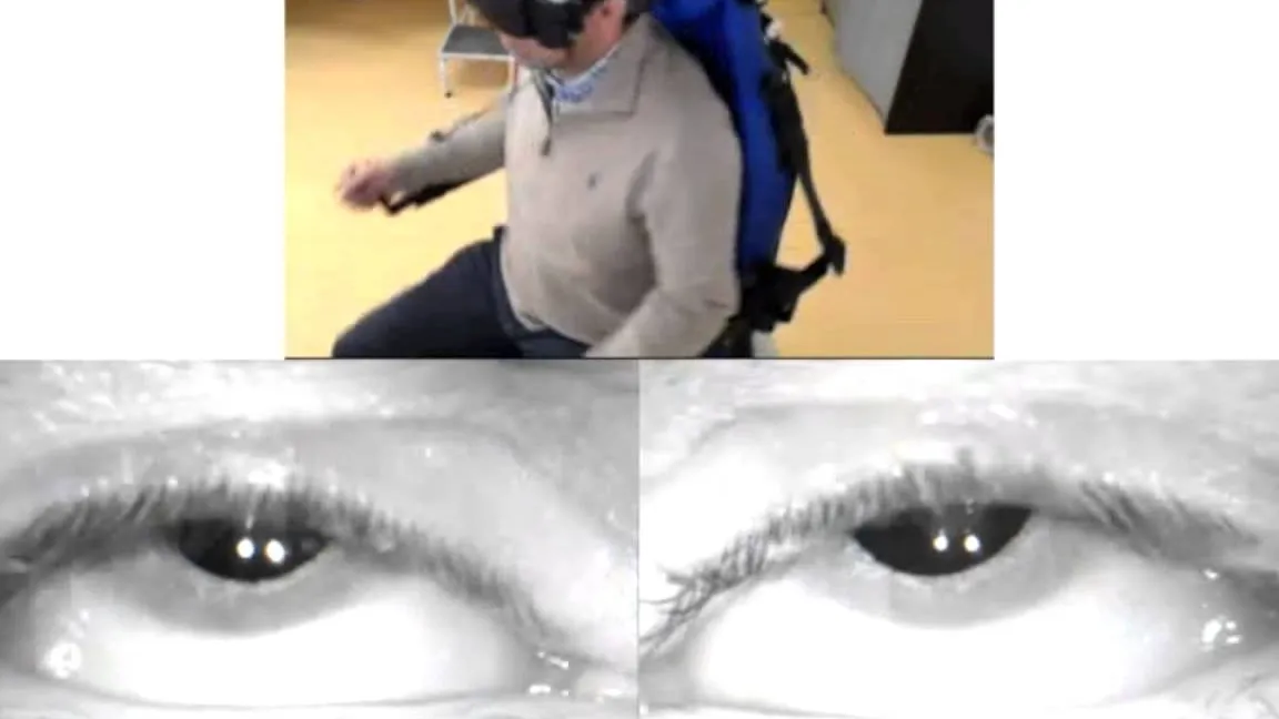 Hipofunción Vestibular (unilateral o bilateral)