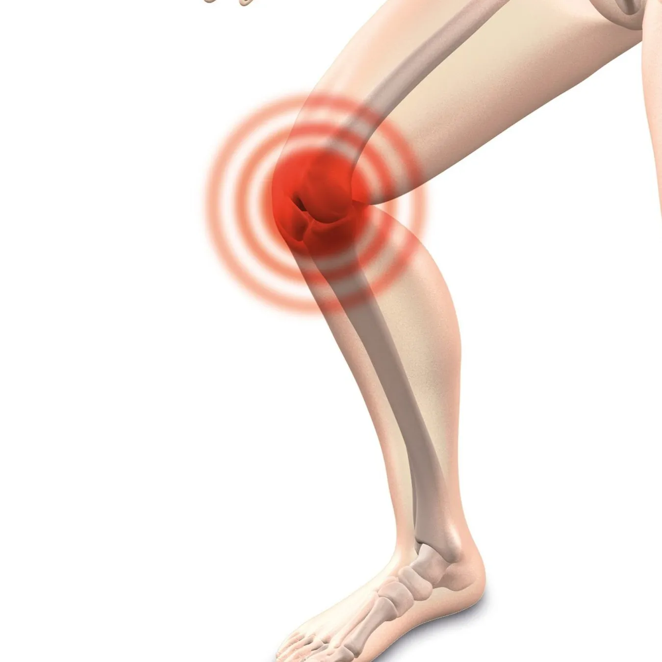 Inflamación en la Región de la Rodilla
