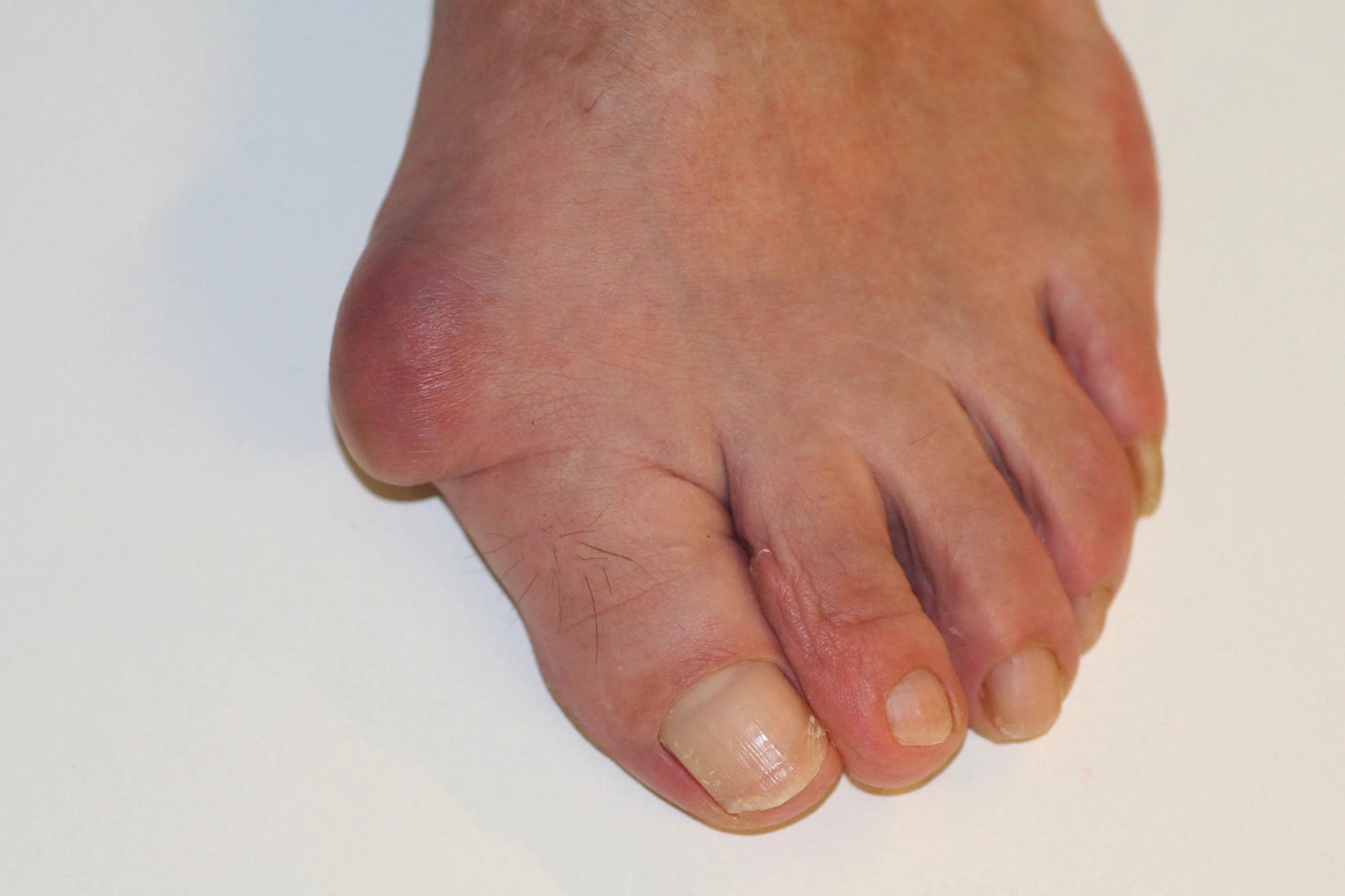 Juanetes (Hallux Valgus)
