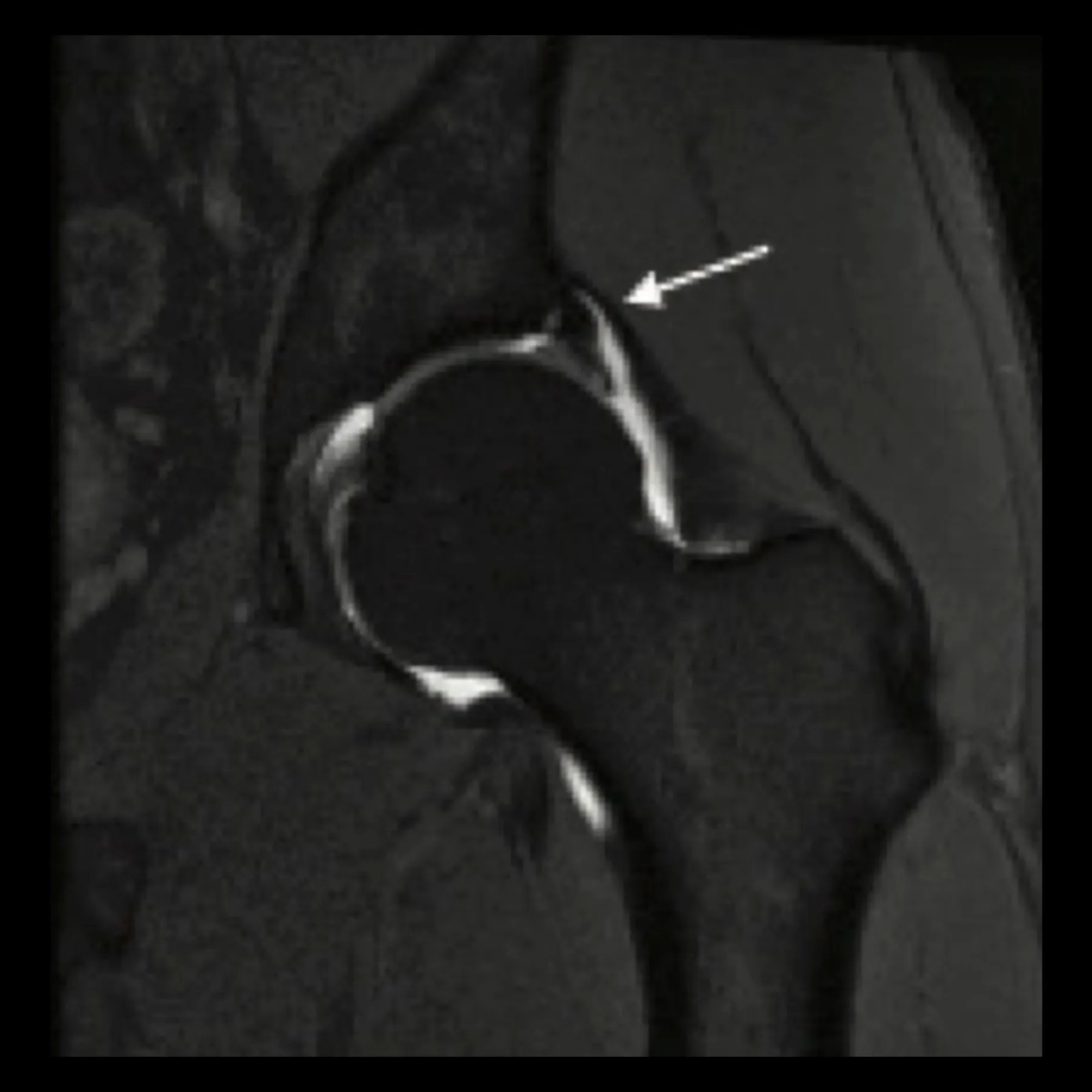 Lesión de labrum de cadera