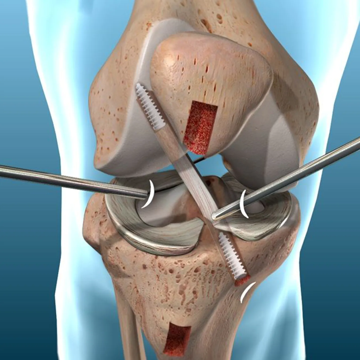 Lesión de Ligamento Alar (Cuello)