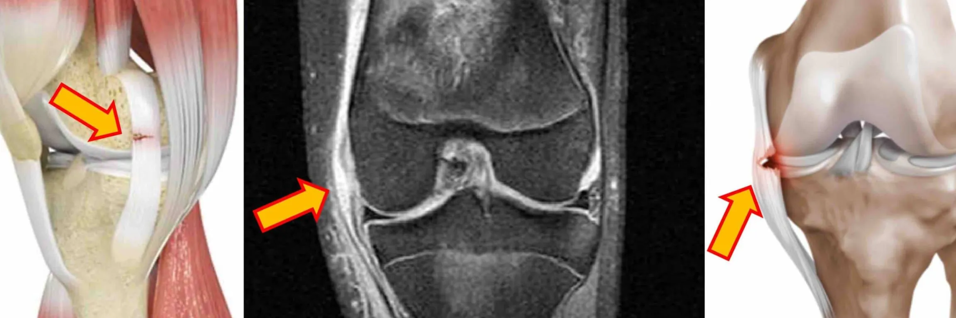 Lesión del Ligamento Colateral Medial (LCM)