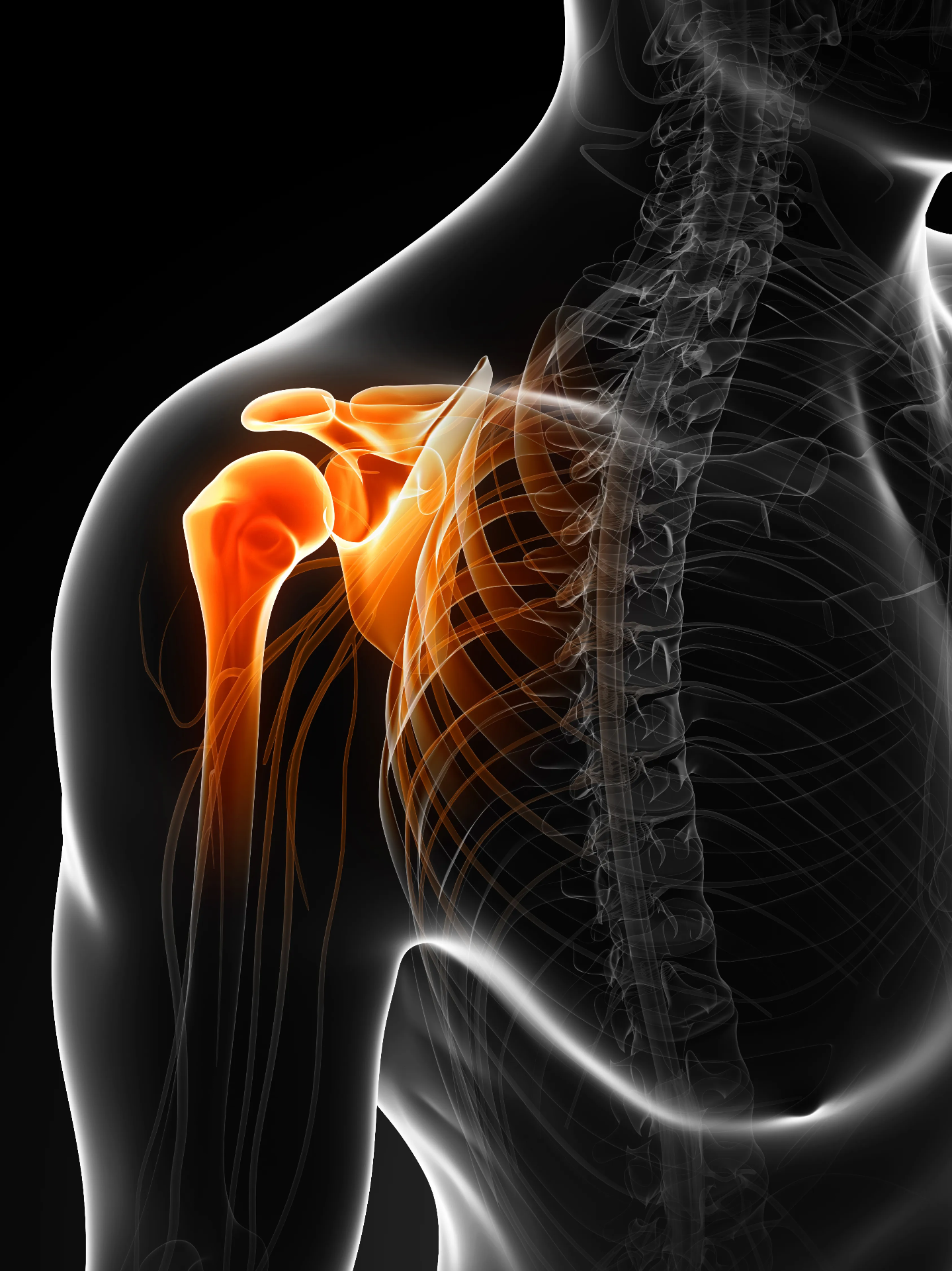 Lesión del Ligamento Coracoclavicular (Hombro)