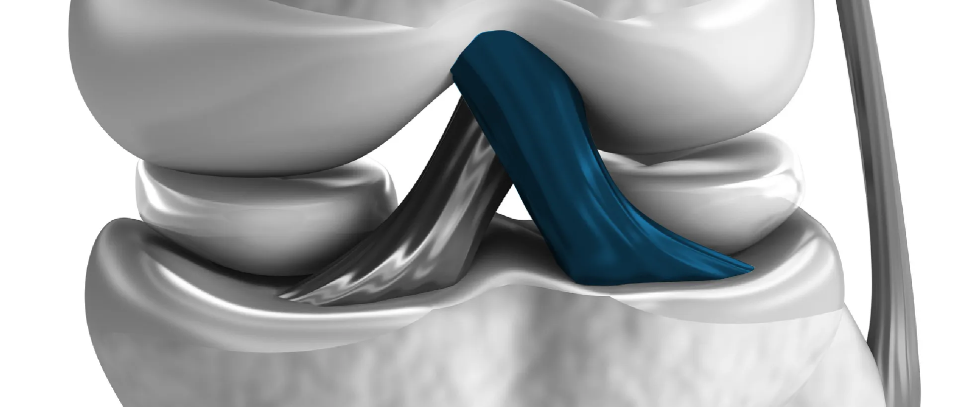 Lesión de ligamento cruzado anterior (LCA)