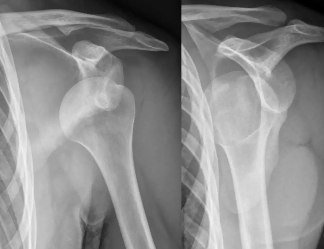 Lesión del Ligamento Escapulohumeral