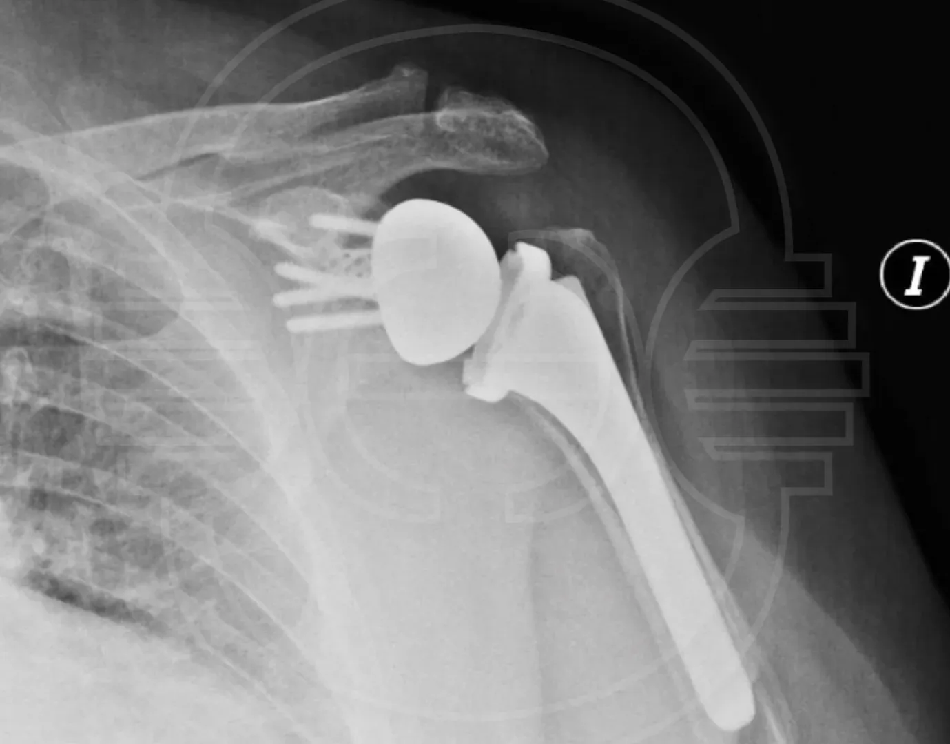 Lesión del Ligamento Glenohumeral (Hombro)