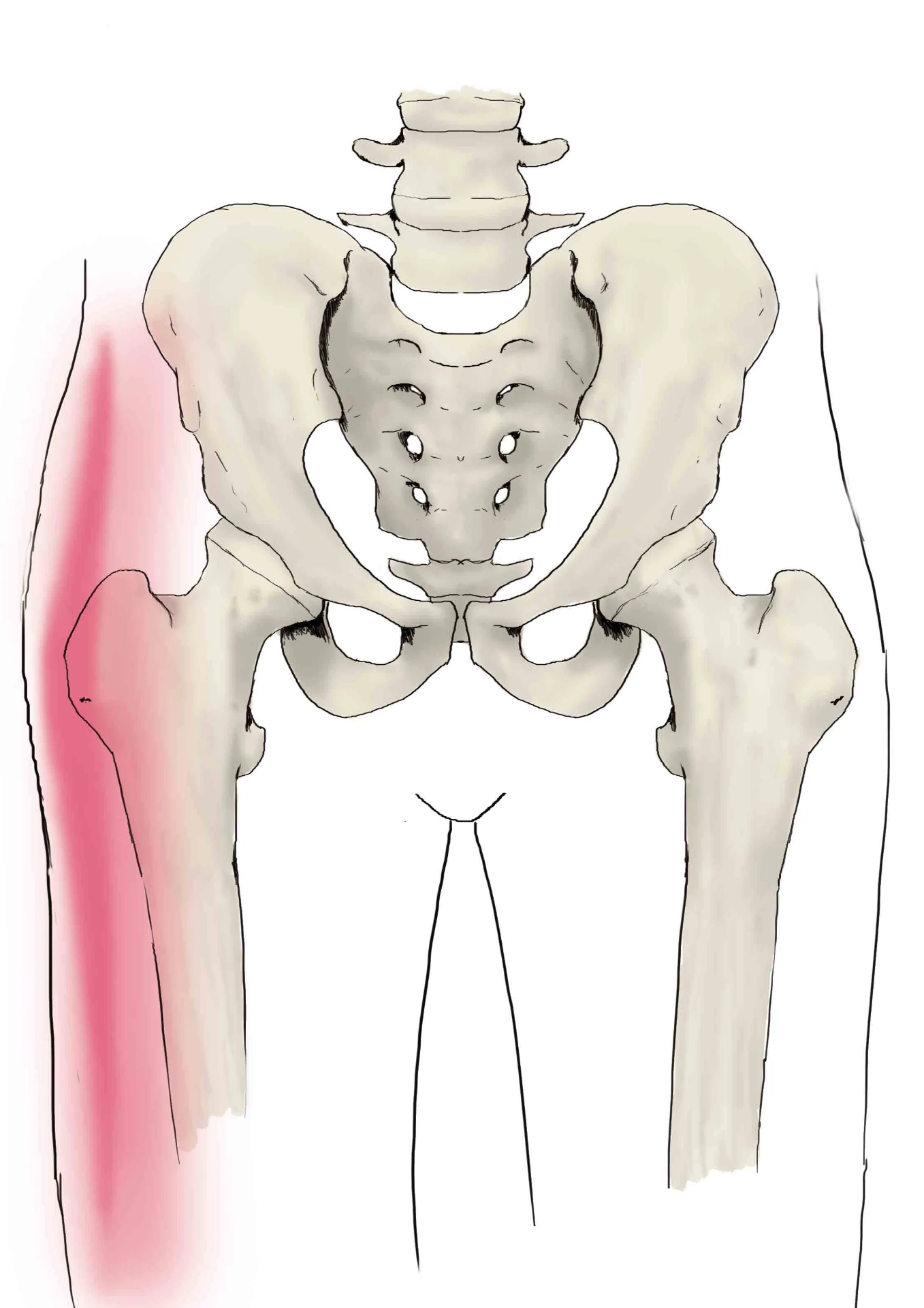 Lesión de Ligamento Iliofemoral (Cadera)