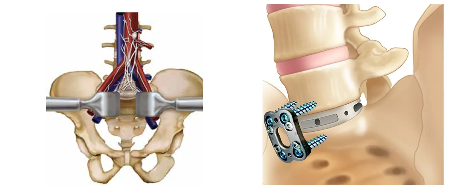 Lesión de Ligamentos Interespinosos (Columna)