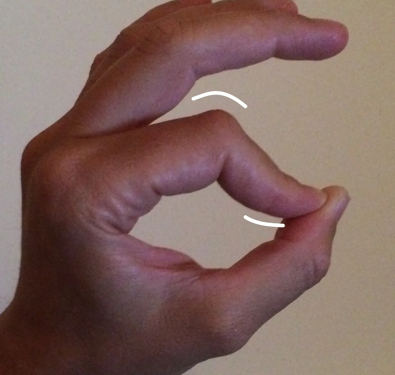 Lesión de ligamentos en el pulgar